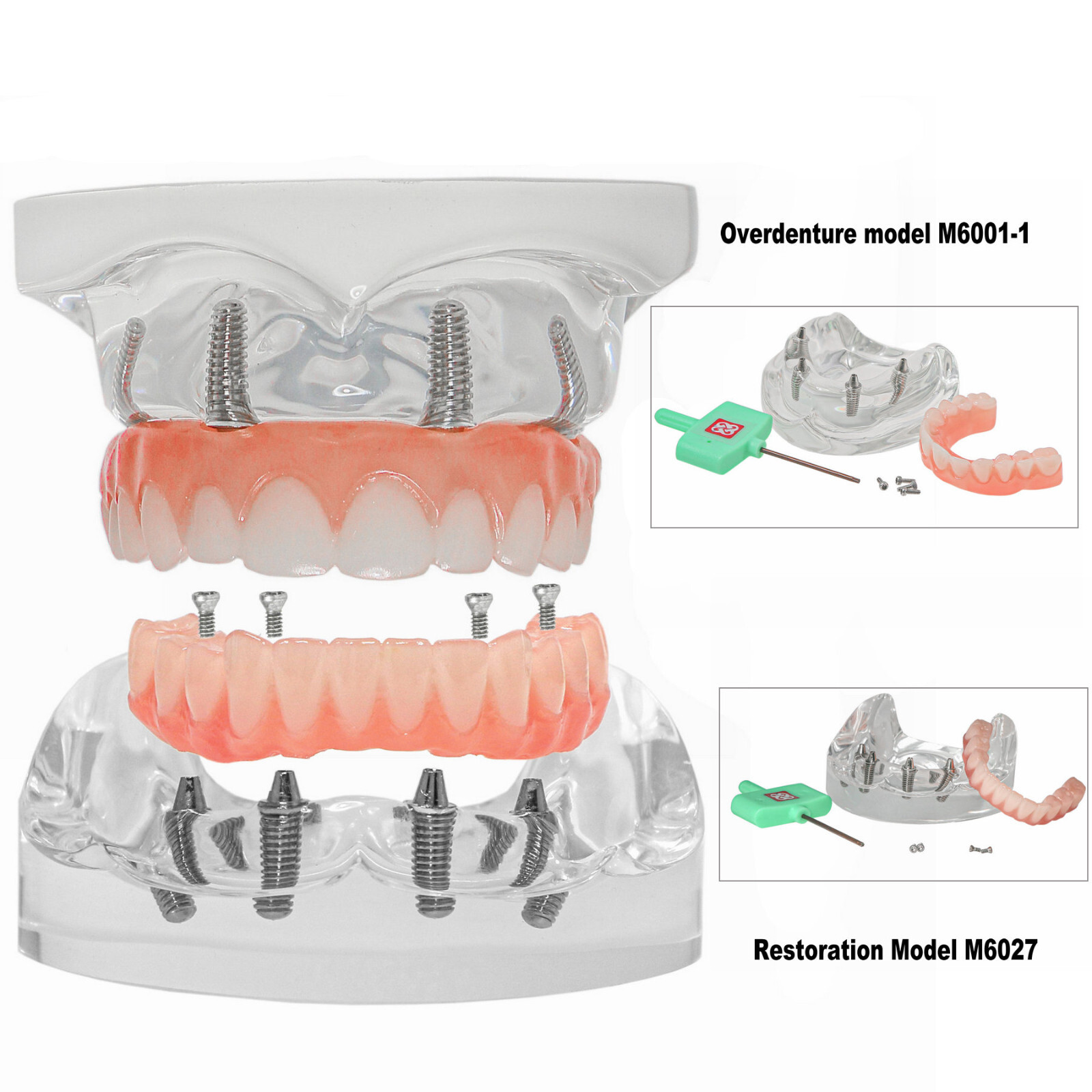 US Dental Overdenture All-on-4 Model Upper/Lower Jaw-Clear Implant With 4 Screws