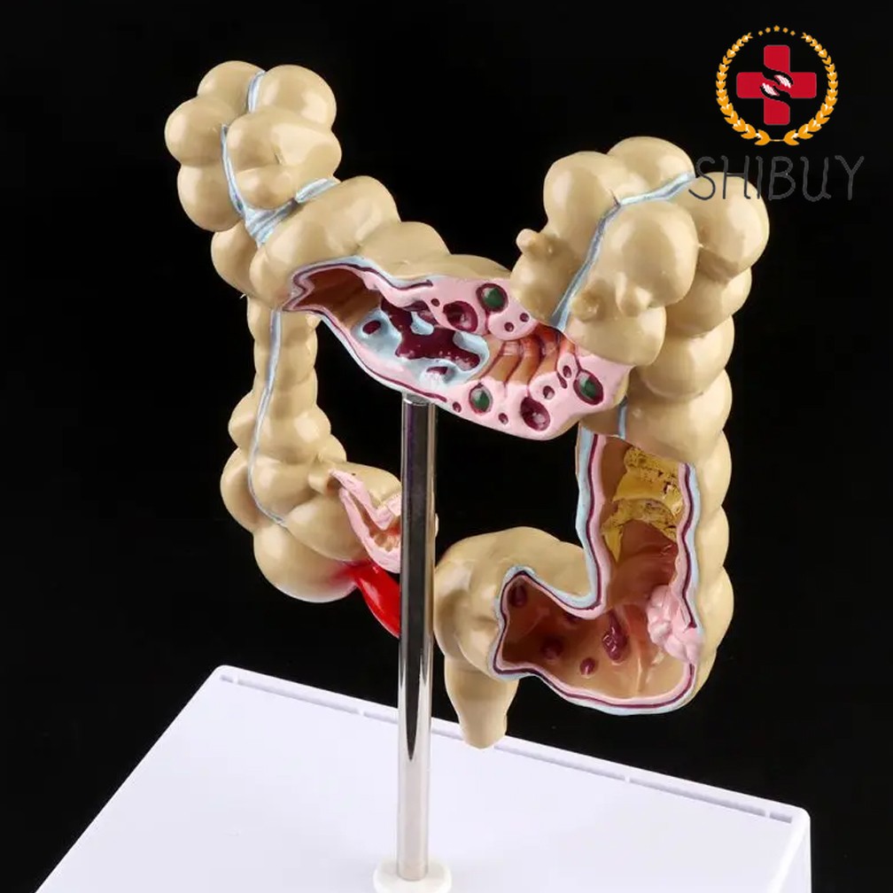 Colorectal Lesion Model Human Colon Snake Large Intestine Pathological Diseases