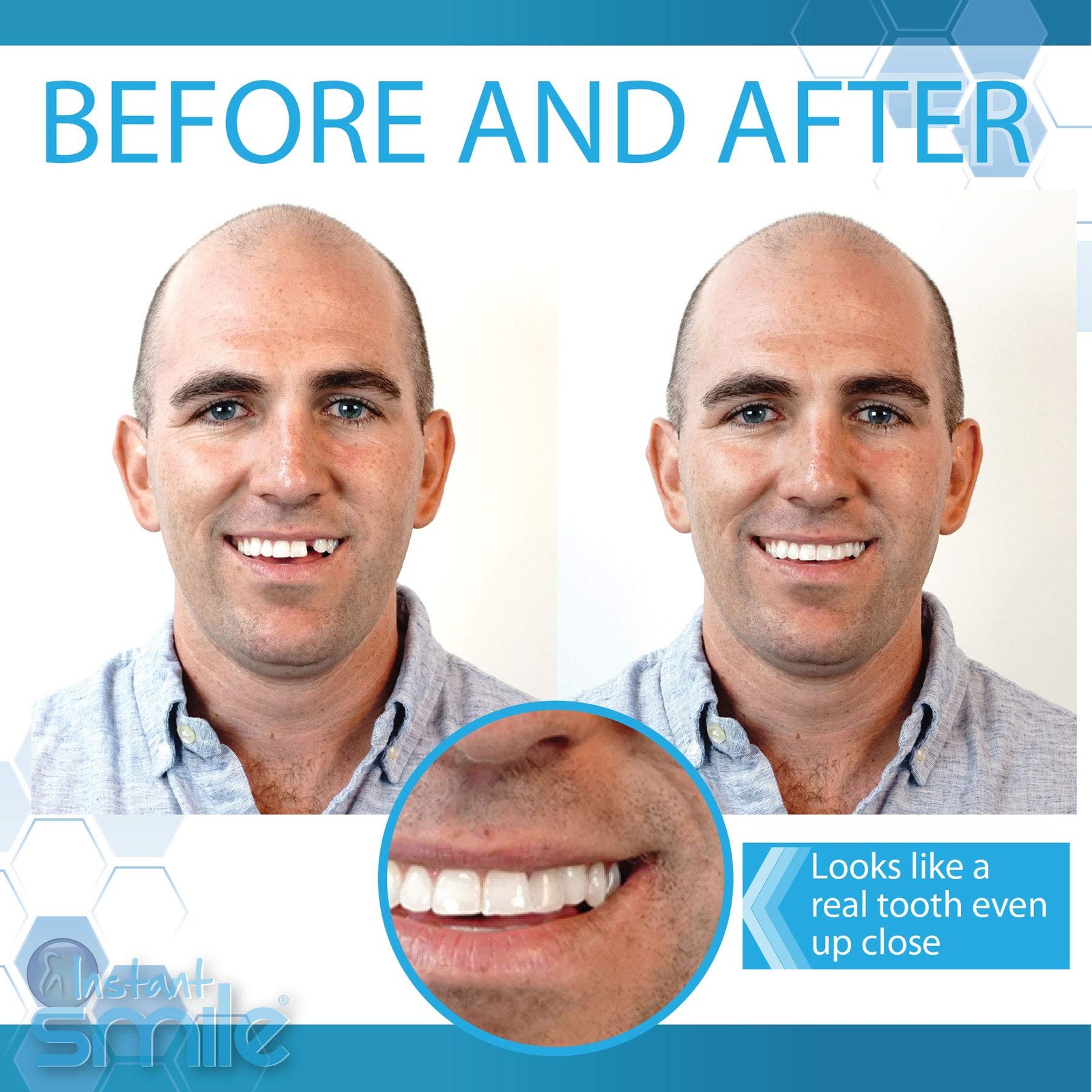 Complete Your Smile Tooth Replacement Kit DELUXE PACK – 1 Count (Pack of 1)