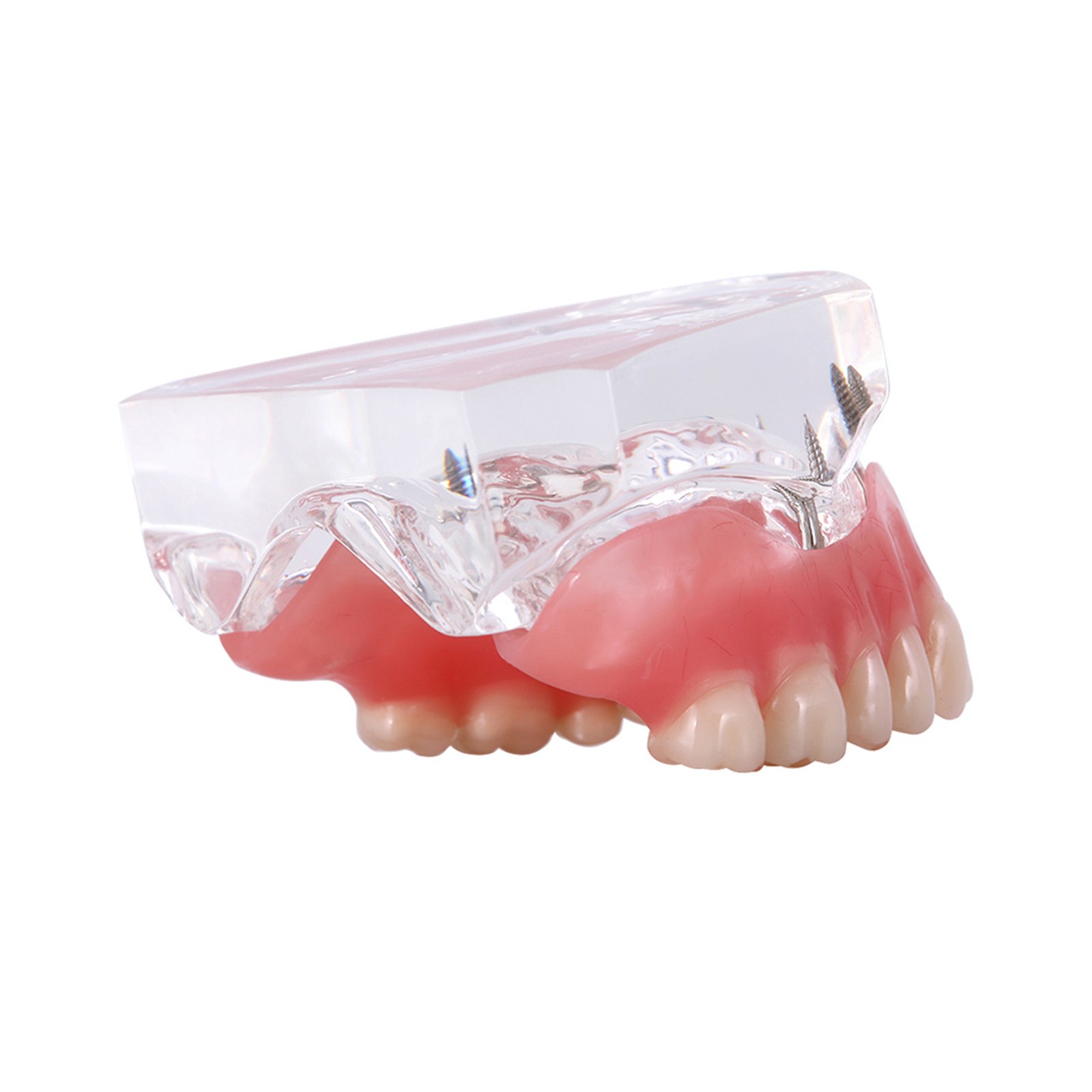 US Dental Model Clear Upper Lower 4 Implants Overdenture Restoration Removable