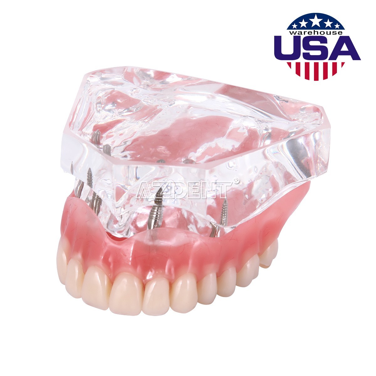 Dental Implant Teeth Model Demo Overdenture Restoration With Implants Lower 6003