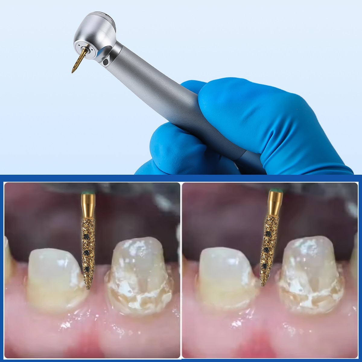 Dental vertical Preparation Diamond Burs Restoration Kit for Anterior Premolar