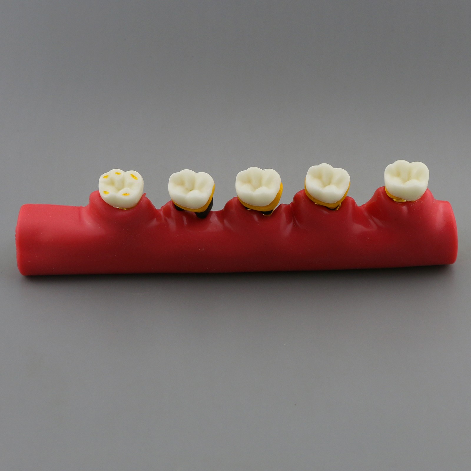 Dental Pathological Model 5 Stage Periodontal Disease Patient Communication Demo