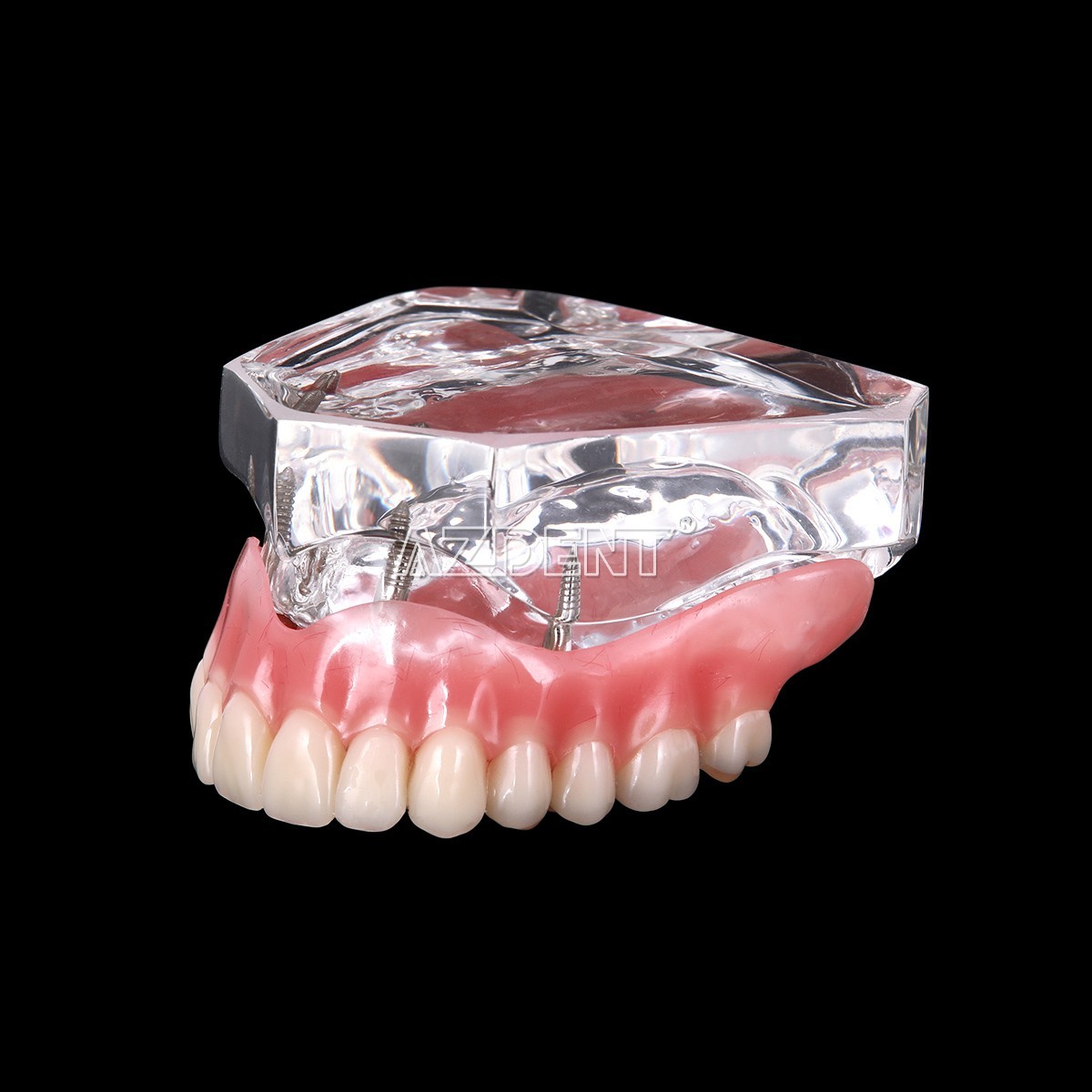 Dental Implant Teeth Model Demo Overdenture Restoration With Implants Lower 6003