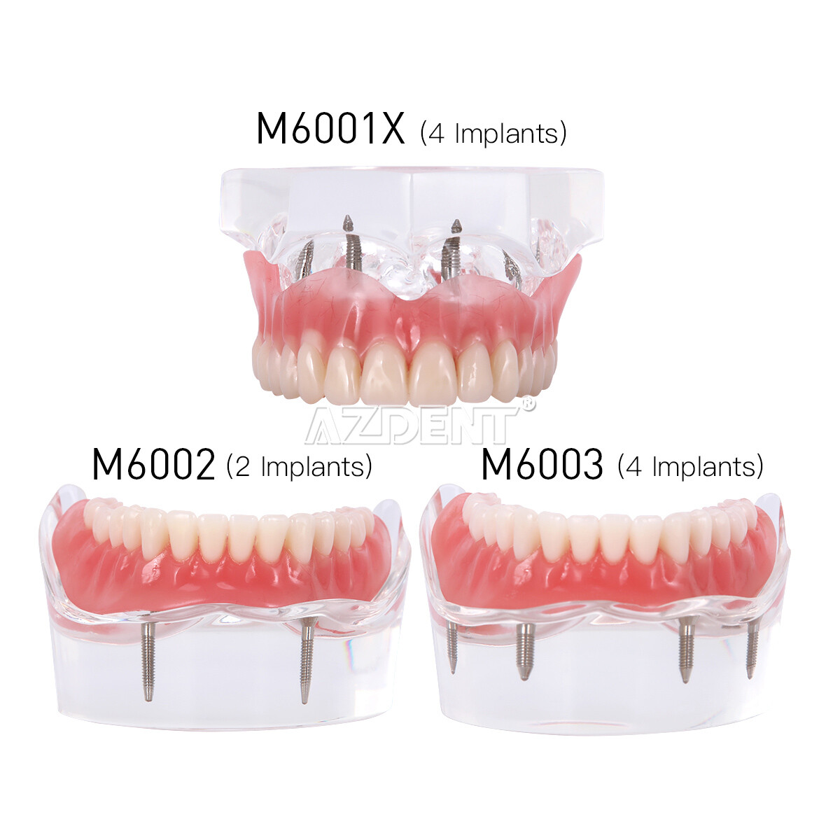 US Dental Implant Teeth Model Demo Overdenture Restoration With Implants U/L