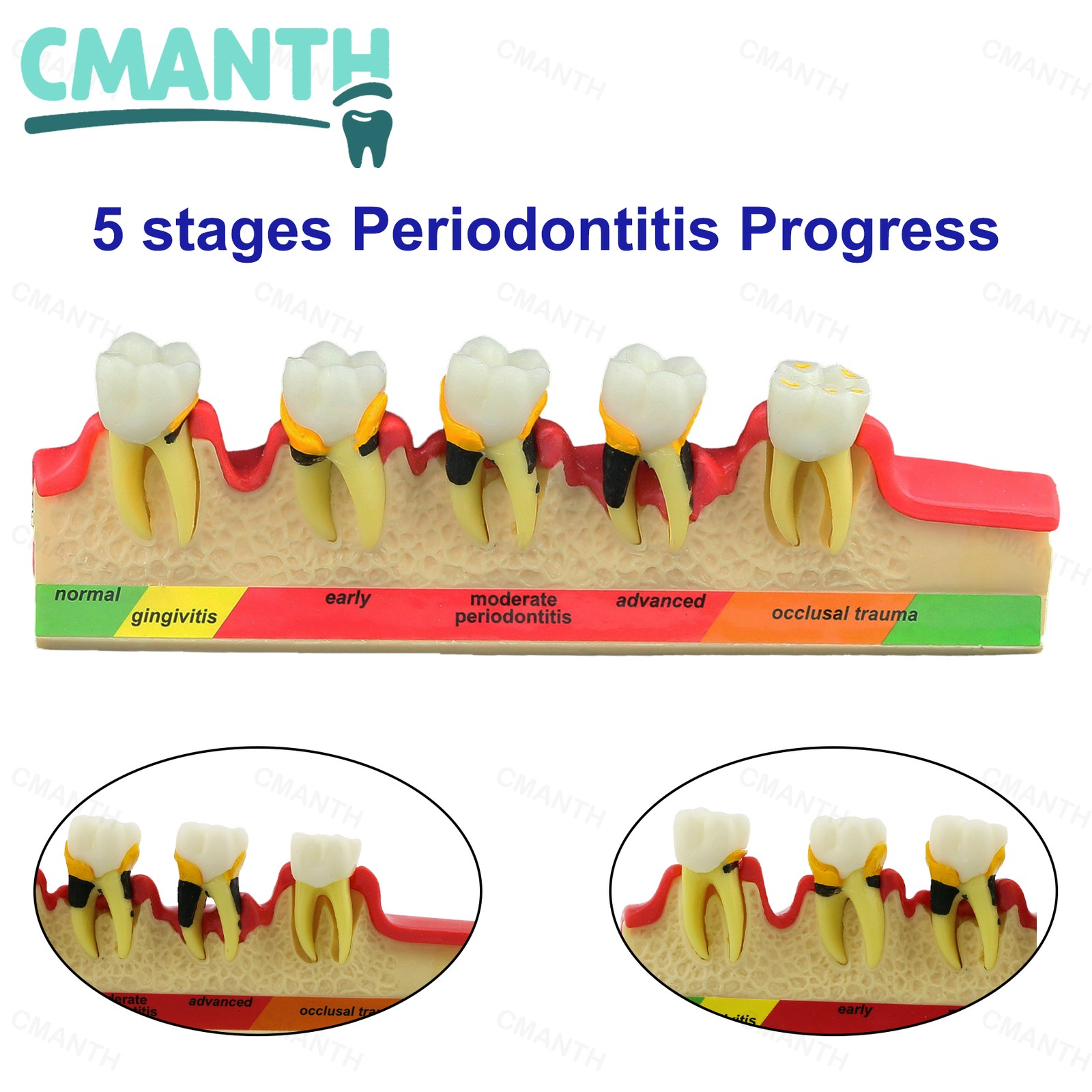 Dental Pathological Model 5 Stage Periodontal Disease Patient Communication Demo