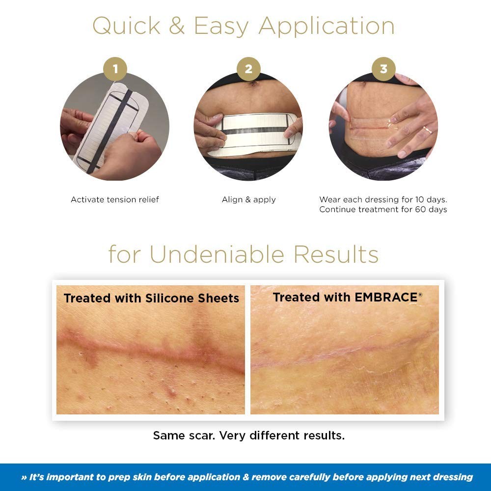 Embrace Active Scar Defense For Scars Fda-Cleared Medical-Grade Silicone Scar