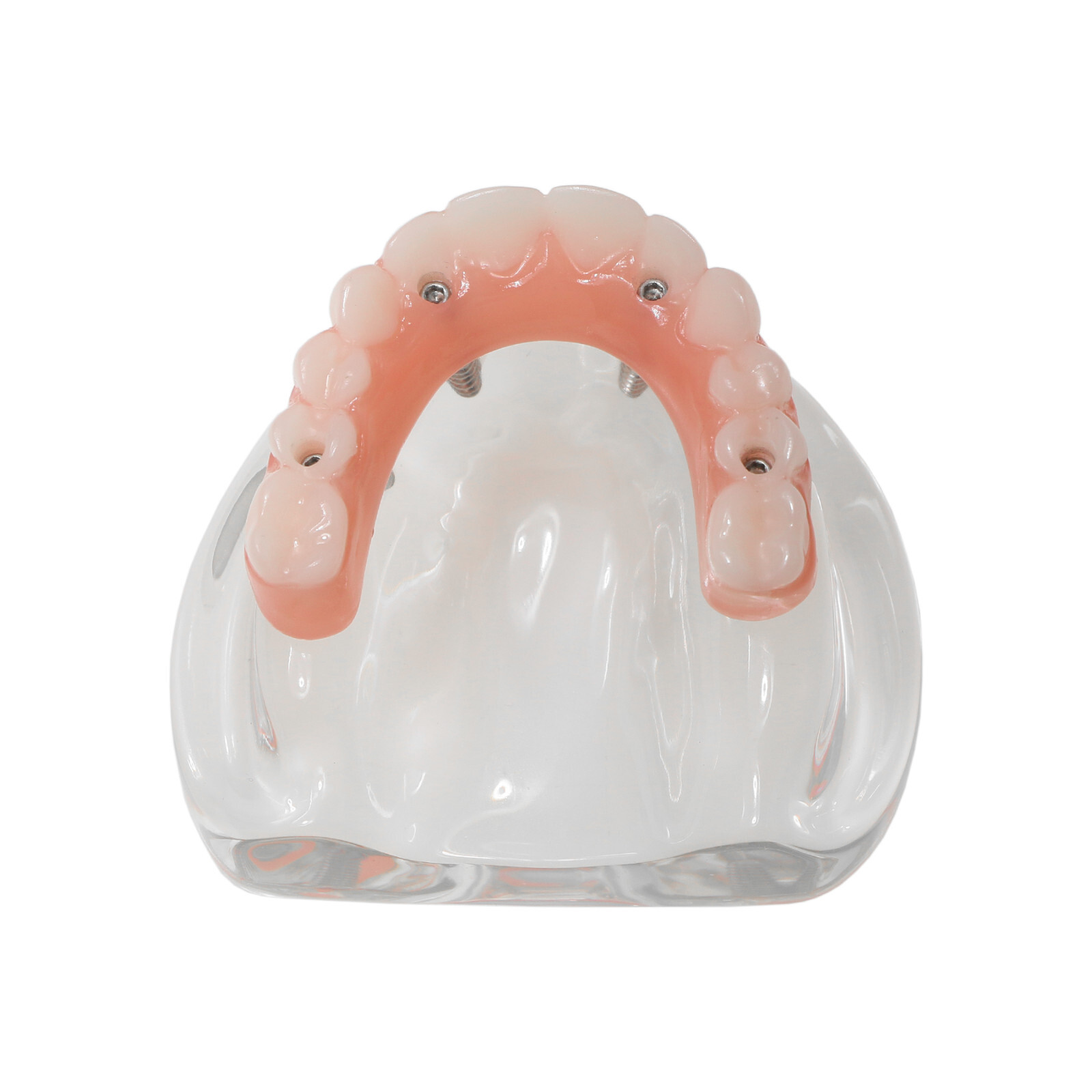 Dental 4 Implants Upper&Lower Demo Implant Teeth Model Restoration Overdenture