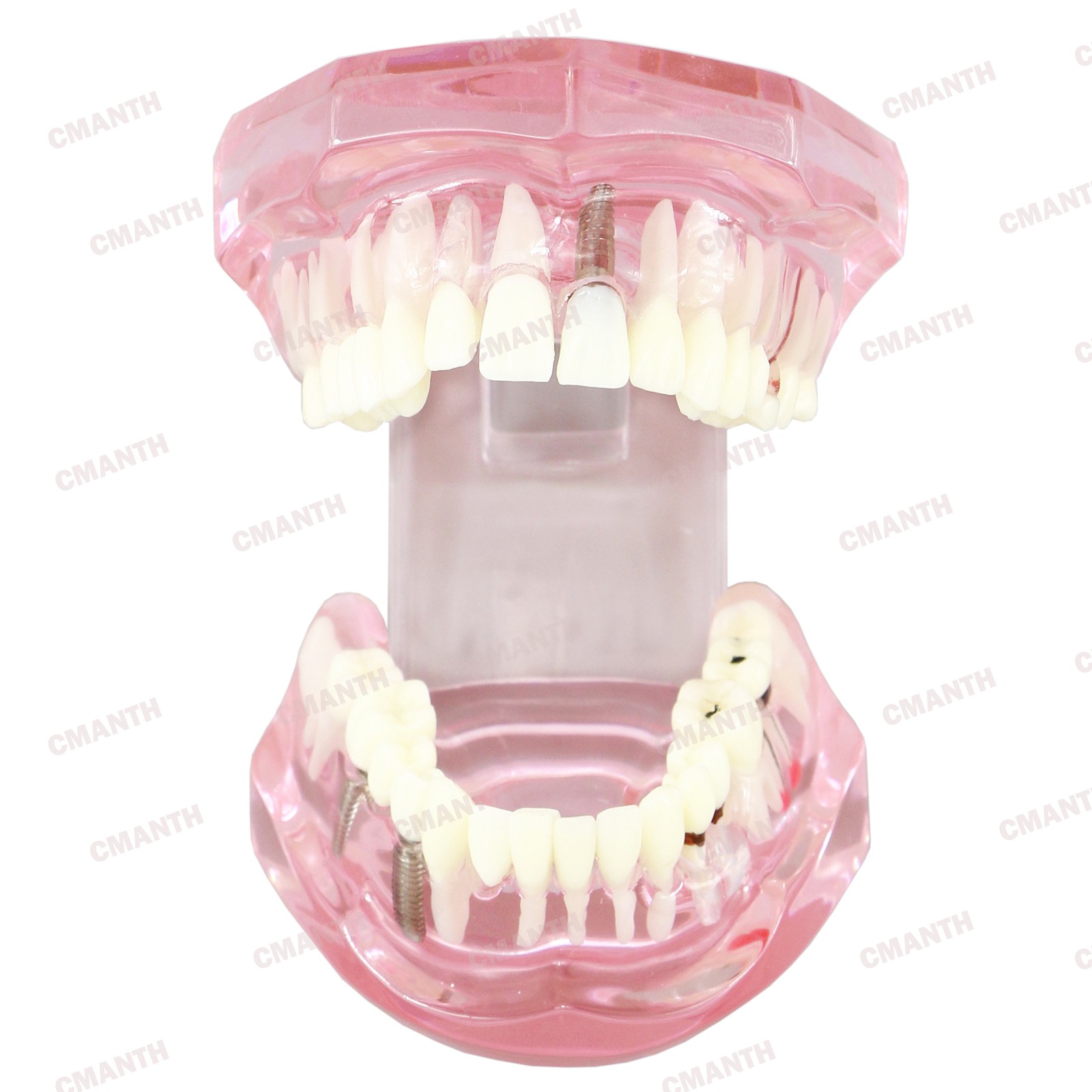 Dental Teeth Model Ortho Implant Practice Teaching of Implants Demo Model