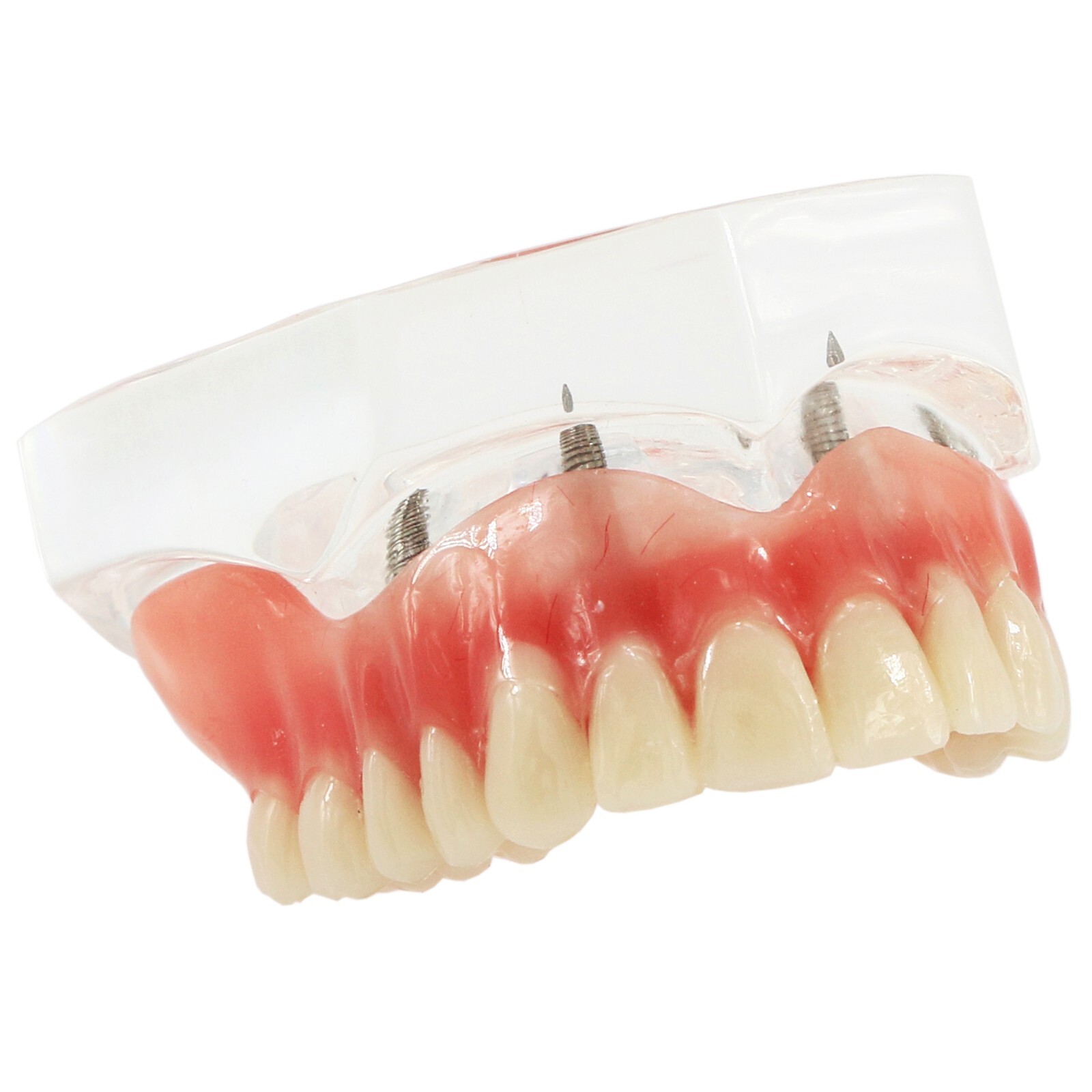 Dental Typodont Teeth Model Implant Pathological Perio Restoration Practice Demo