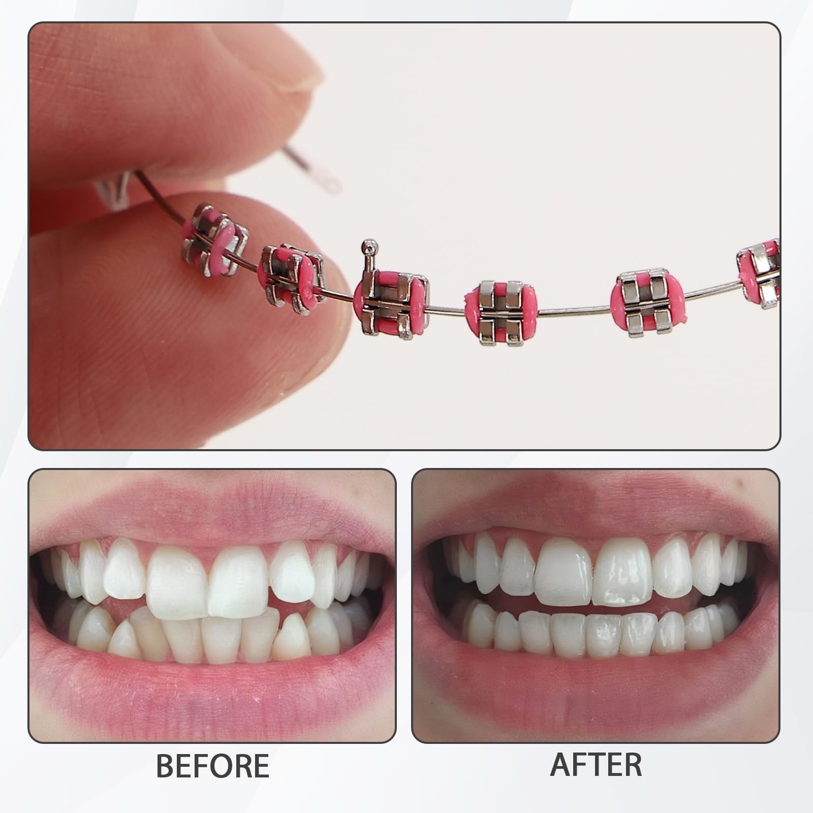 1 Pair Temporary Removable Teeth Braces, Clip on Braces for Teeth with Metal