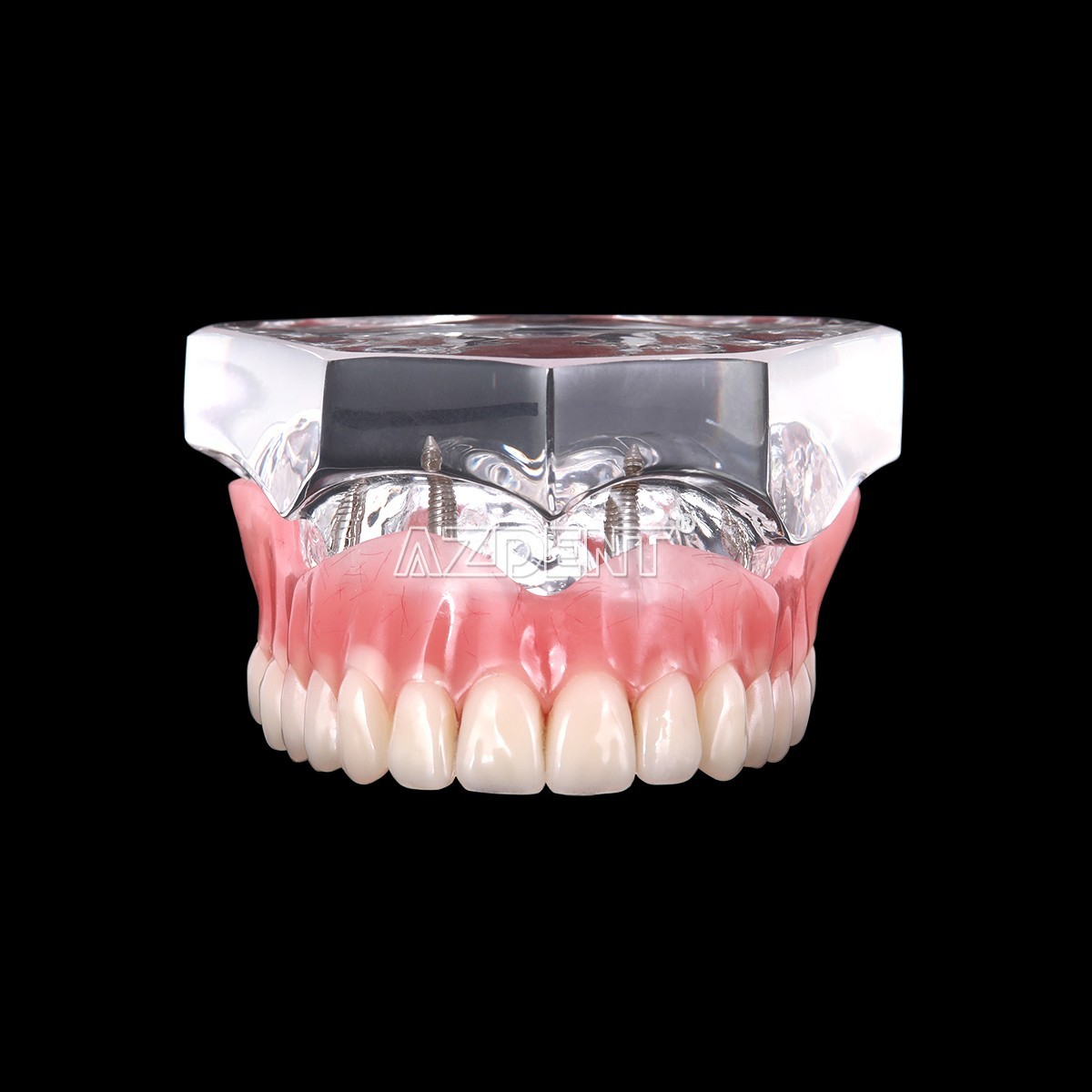 Dental Implant Teeth Model Demo Overdenture Restoration With Implants Lower 6003