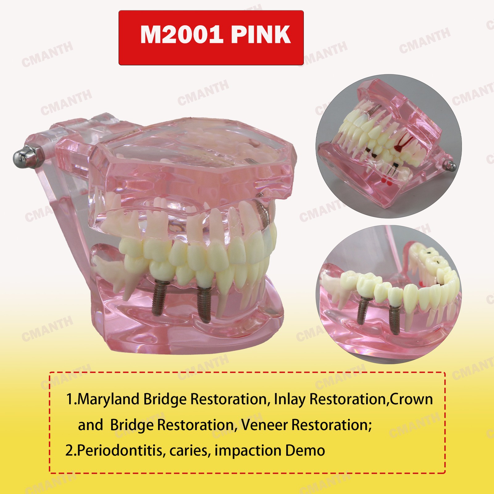 Dental Teeth Model Ortho Implant Practice Teaching of Implants Demo Model