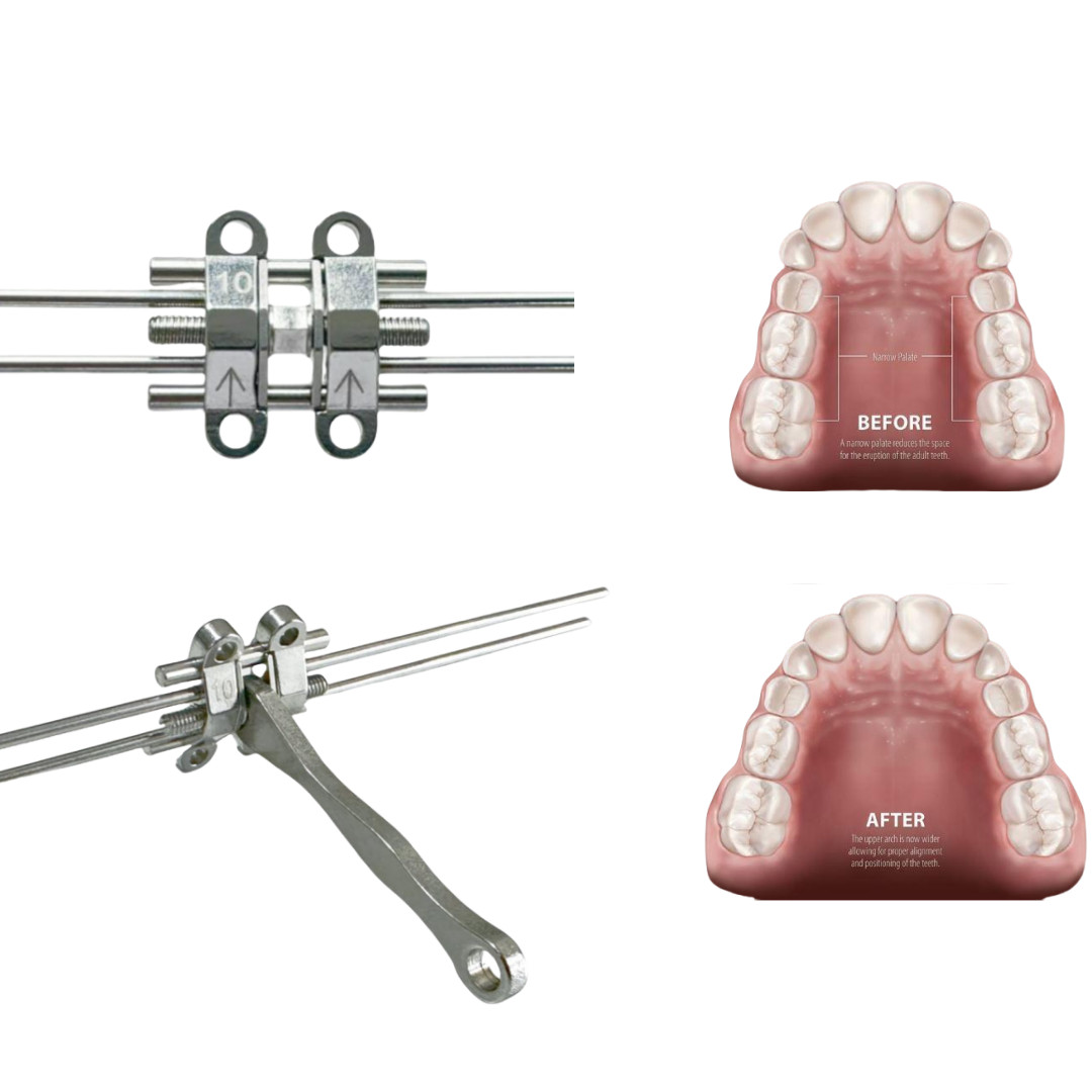 MSE Dental Expansion Screw Facial Rapid Split Maxillary Skeletal Expander Kit