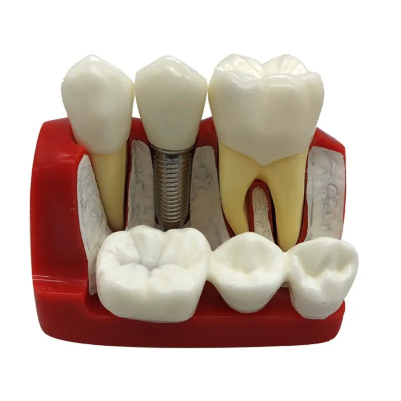 iDentical Implant Analysis Model – M2017 Comprehensive implant analysis model fo