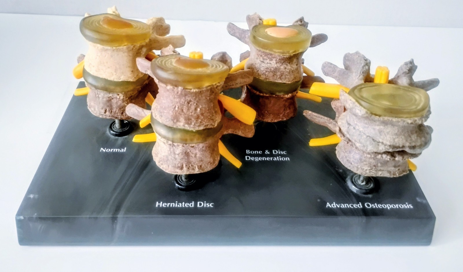 Human Lumbar Vertebrae Degenerative Disc Disease Model Anatomical Medical