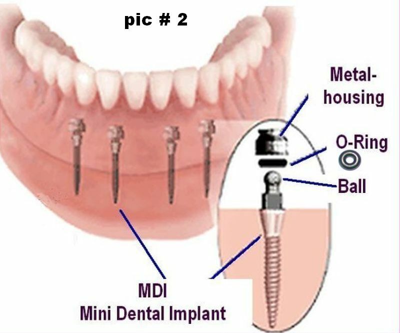 TOOL # 2 for dental implants – comes with 12 O-Rings size 2 – INTRA LOCK ONLY