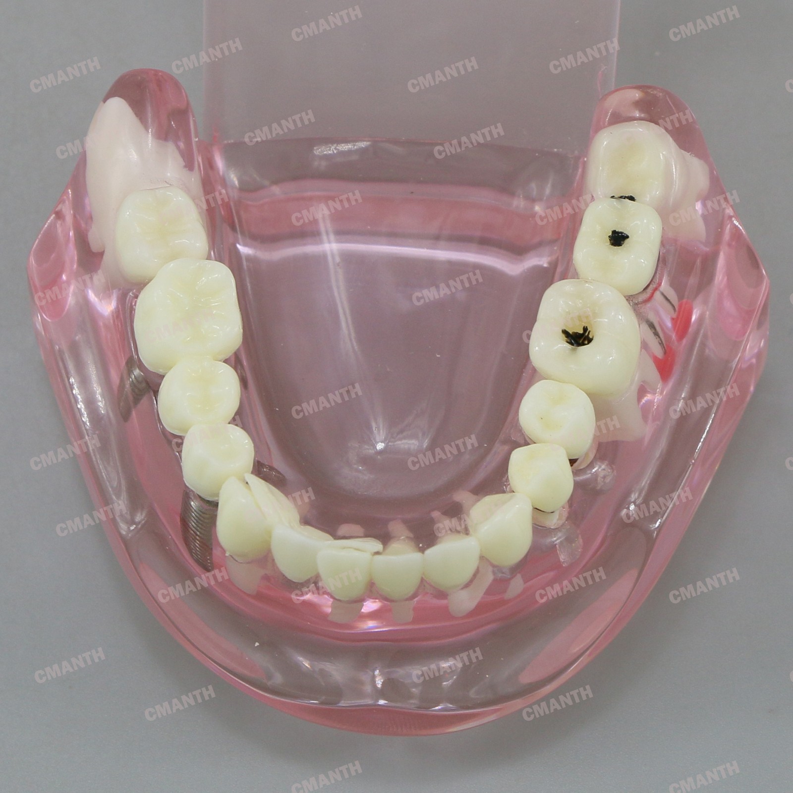 Dental Teeth Model Ortho Implant Practice Teaching of Implants Demo Model