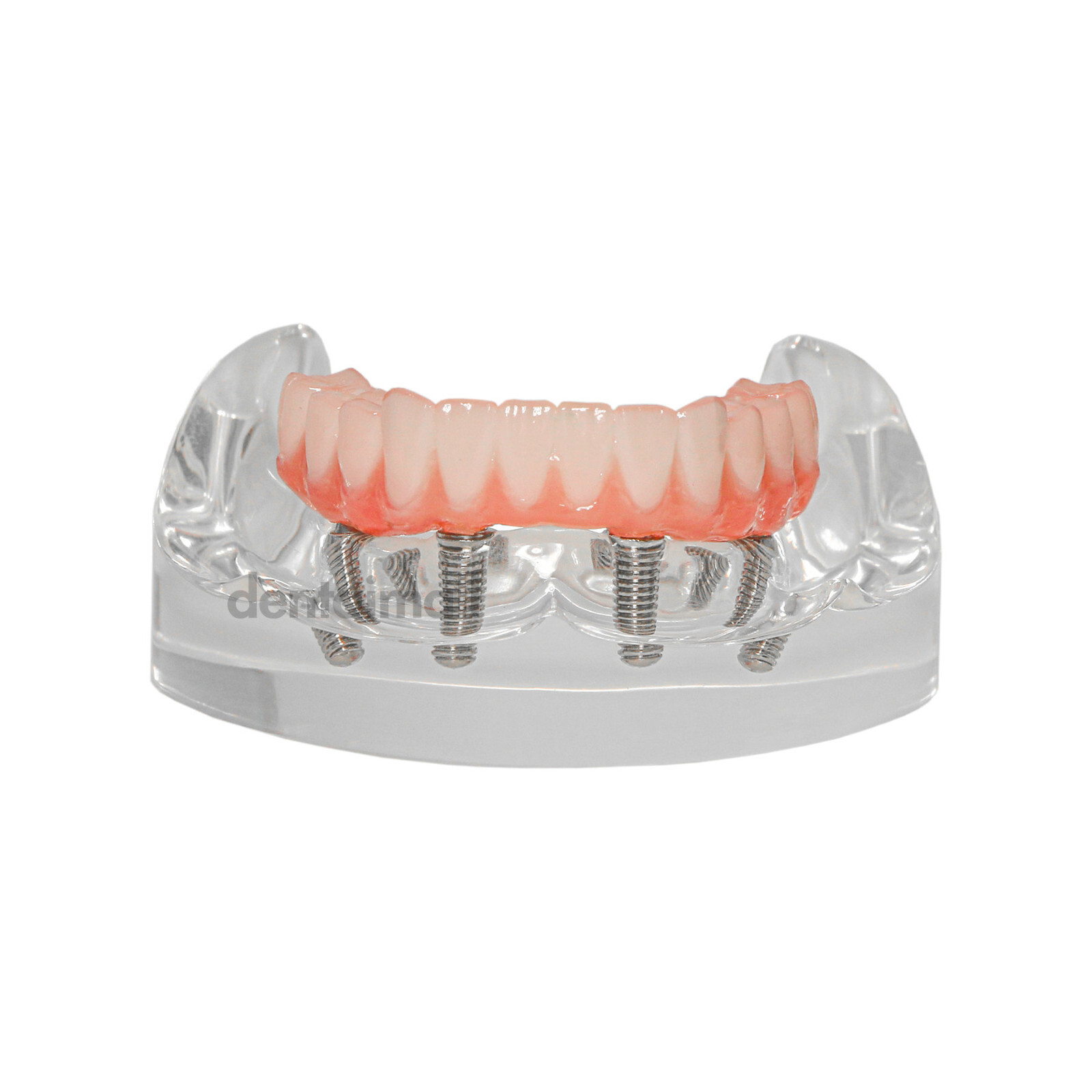 US Dental 4 Screws Overdenture Model All on 4 Restoration Upper/Lower Jaw Type