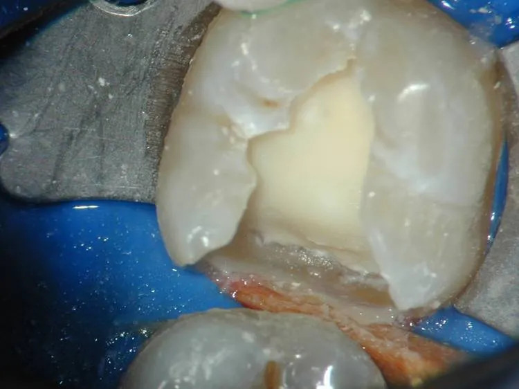Medicept is a versatill material designed to serve as a liner and base PACK OF 1