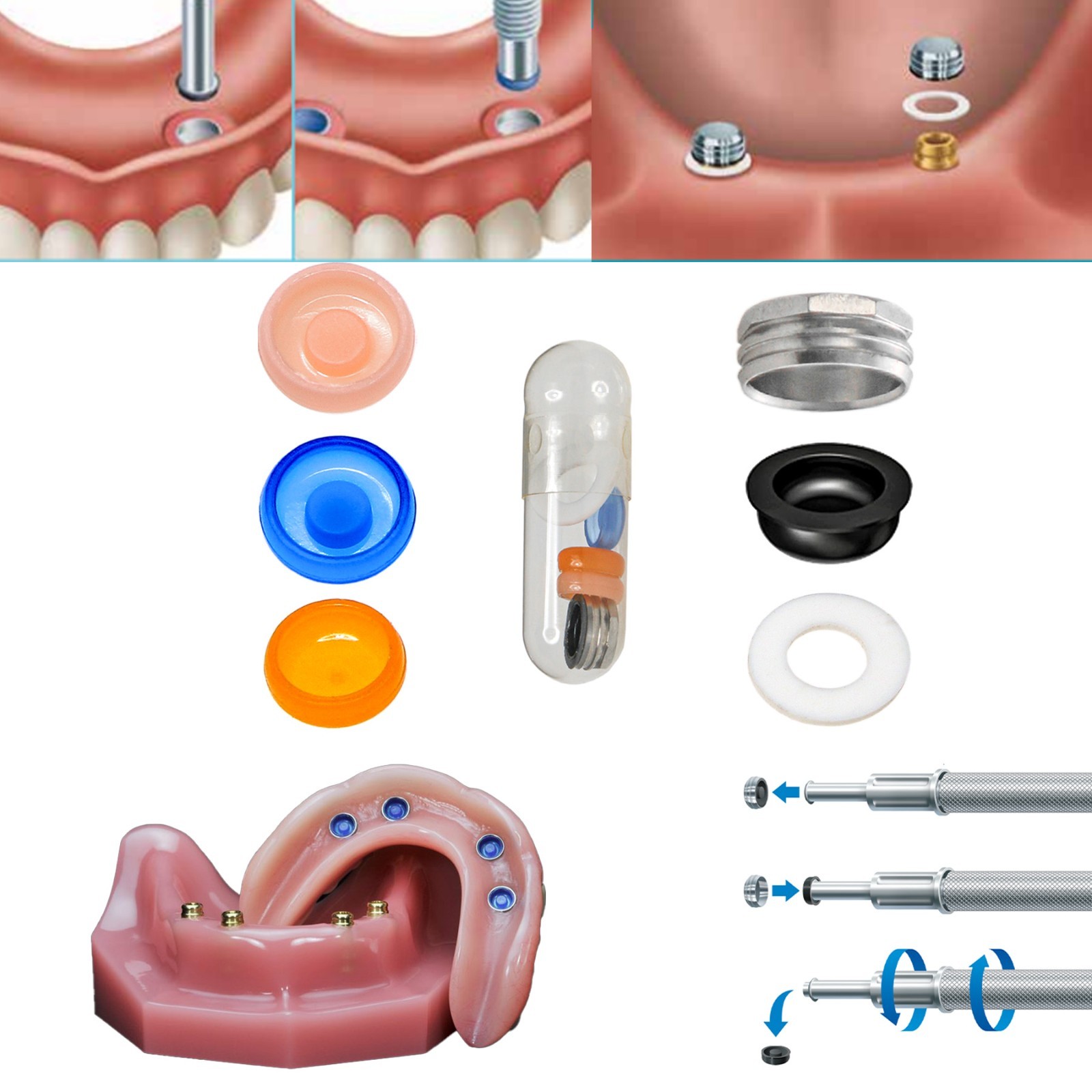 For Zest Locator Overdenture Retention Cap Set & Core Tool Insertion Removal Kit