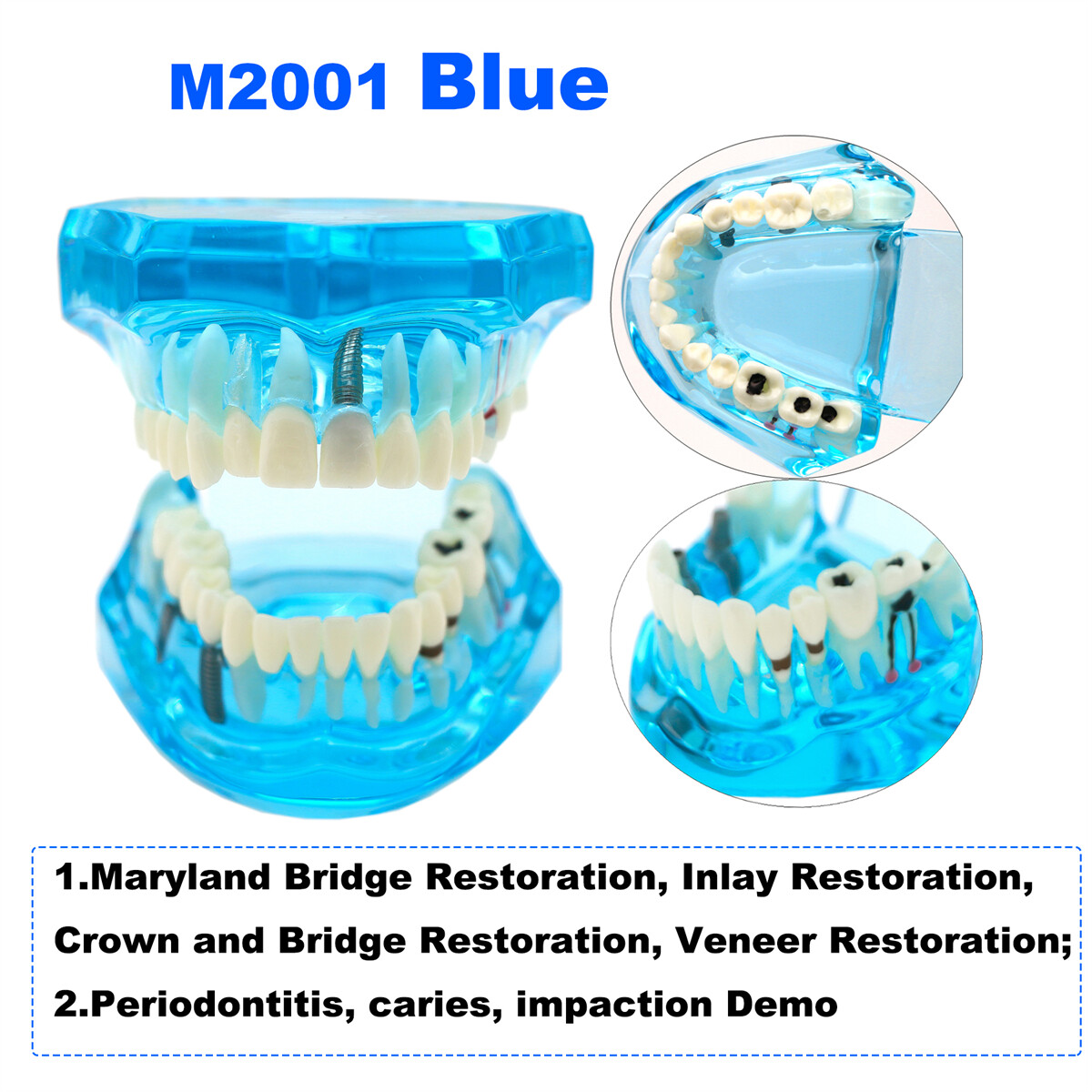 US Dental Teeth Model Ortho Implant Pathological Perio Practice Demo Study Model