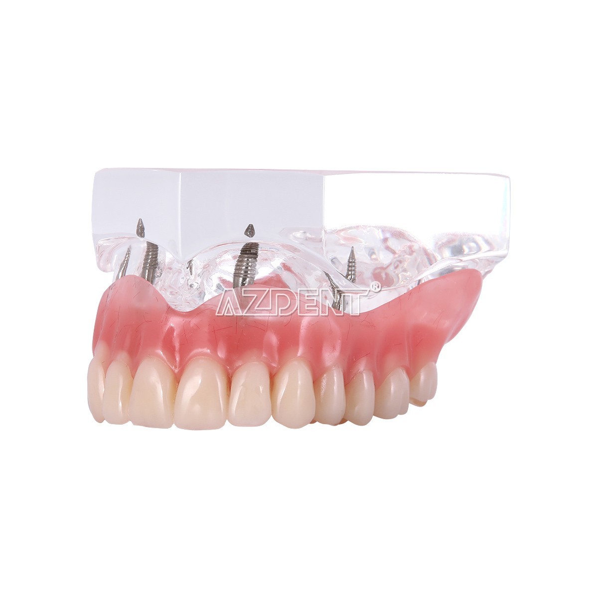 Dental Implant Teeth Model Demo Overdenture Restoration With Implants Lower 6003
