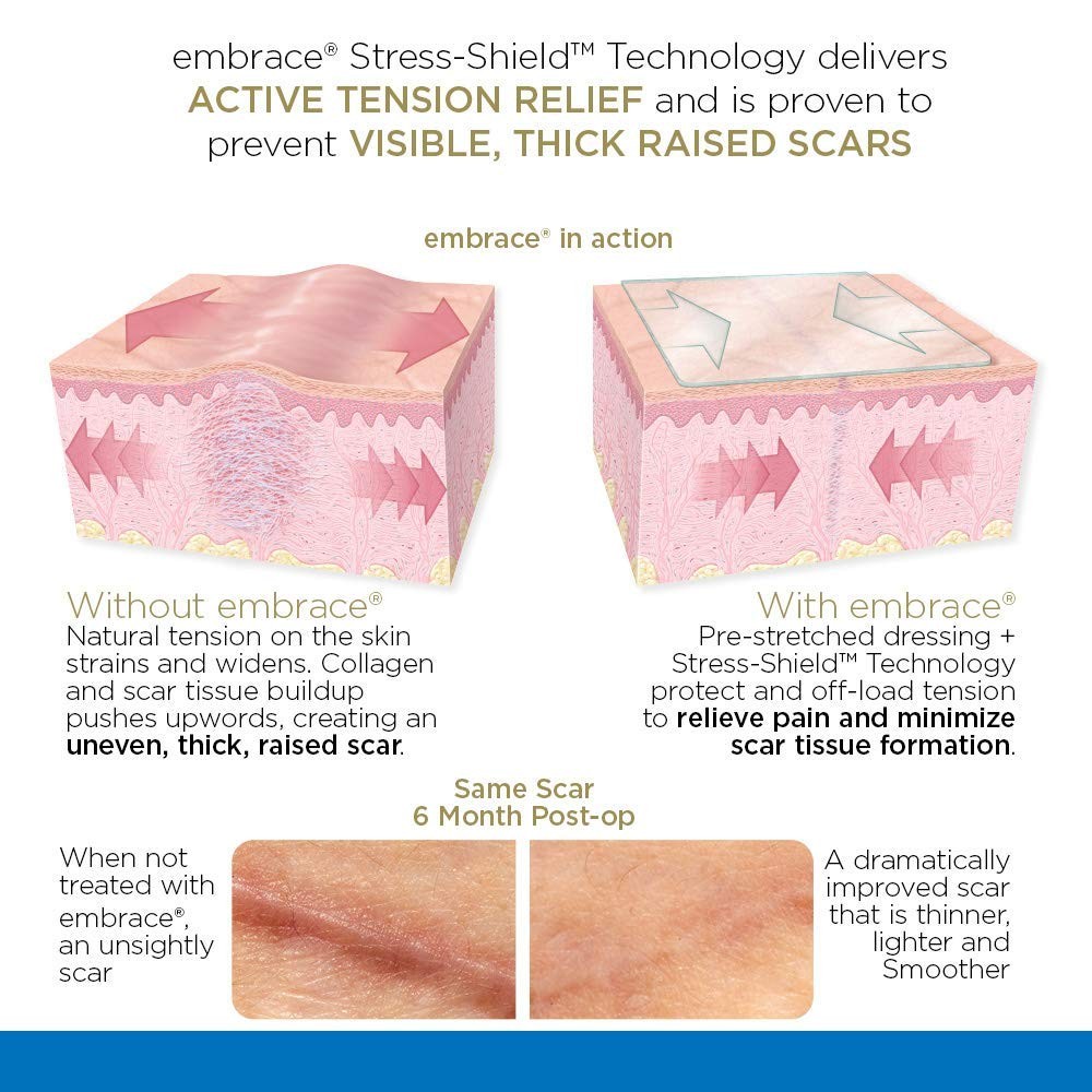 Embrace Active Scar Defense For Scars Fda-Cleared Medical-Grade Silicone Scar