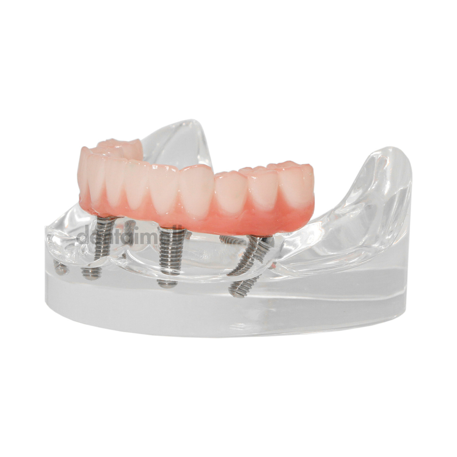 US Dental 4 Screws Overdenture Model All on 4 Restoration Upper/Lower Jaw Type