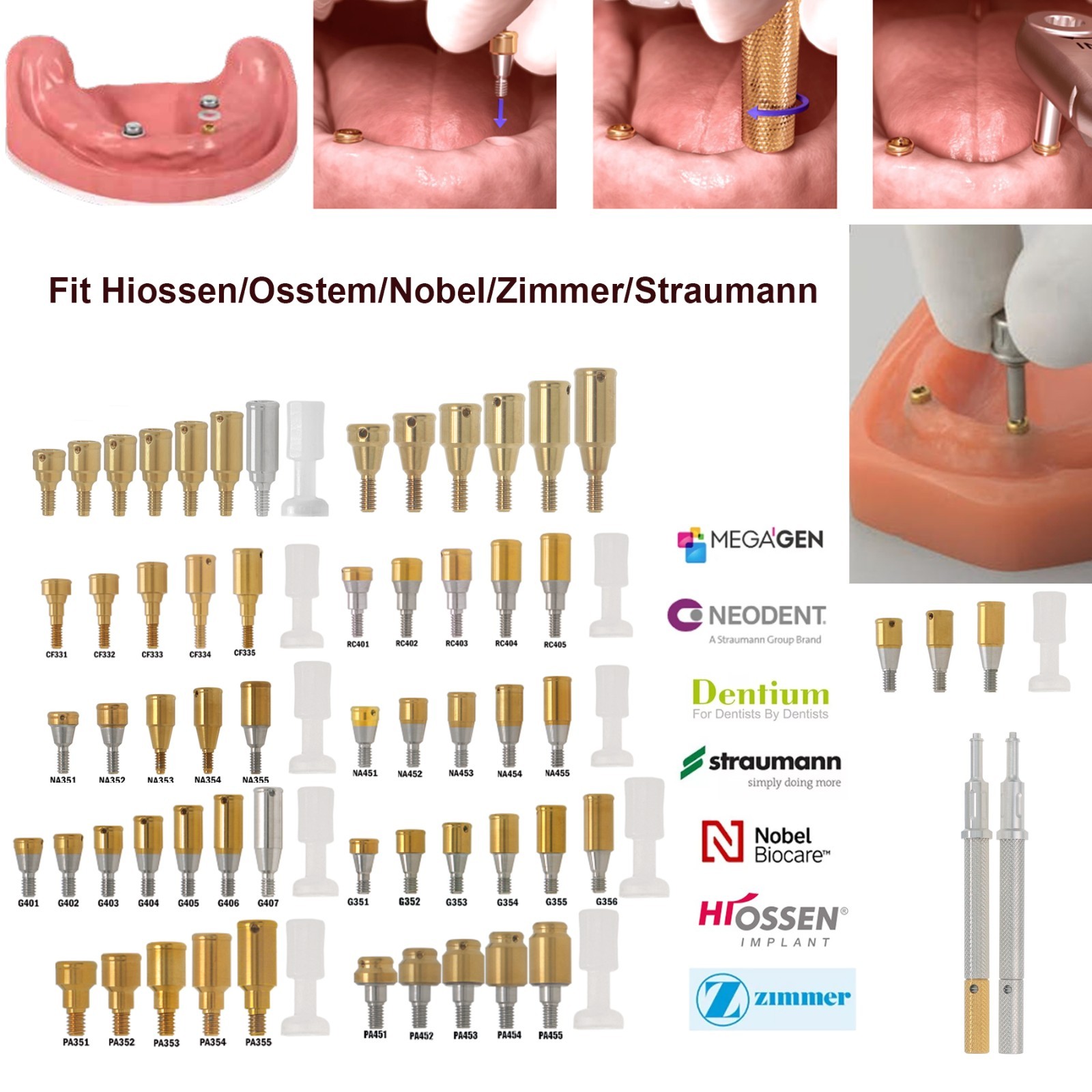 Dental Locator Abutment Compatible Multi Implant Systems Overdenture Attachment