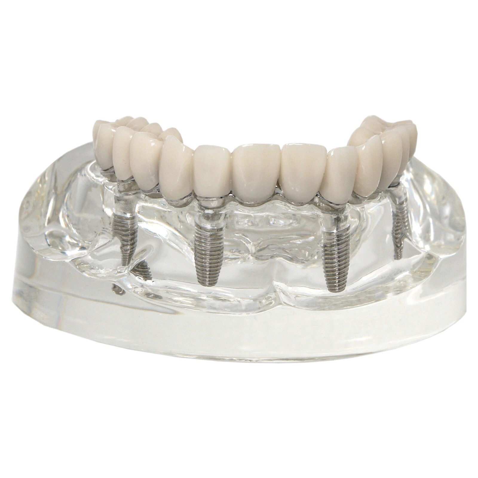 Implants Dental All-on-4 Overdenture Model Upper Jaw Restoration 4 Screws M6023