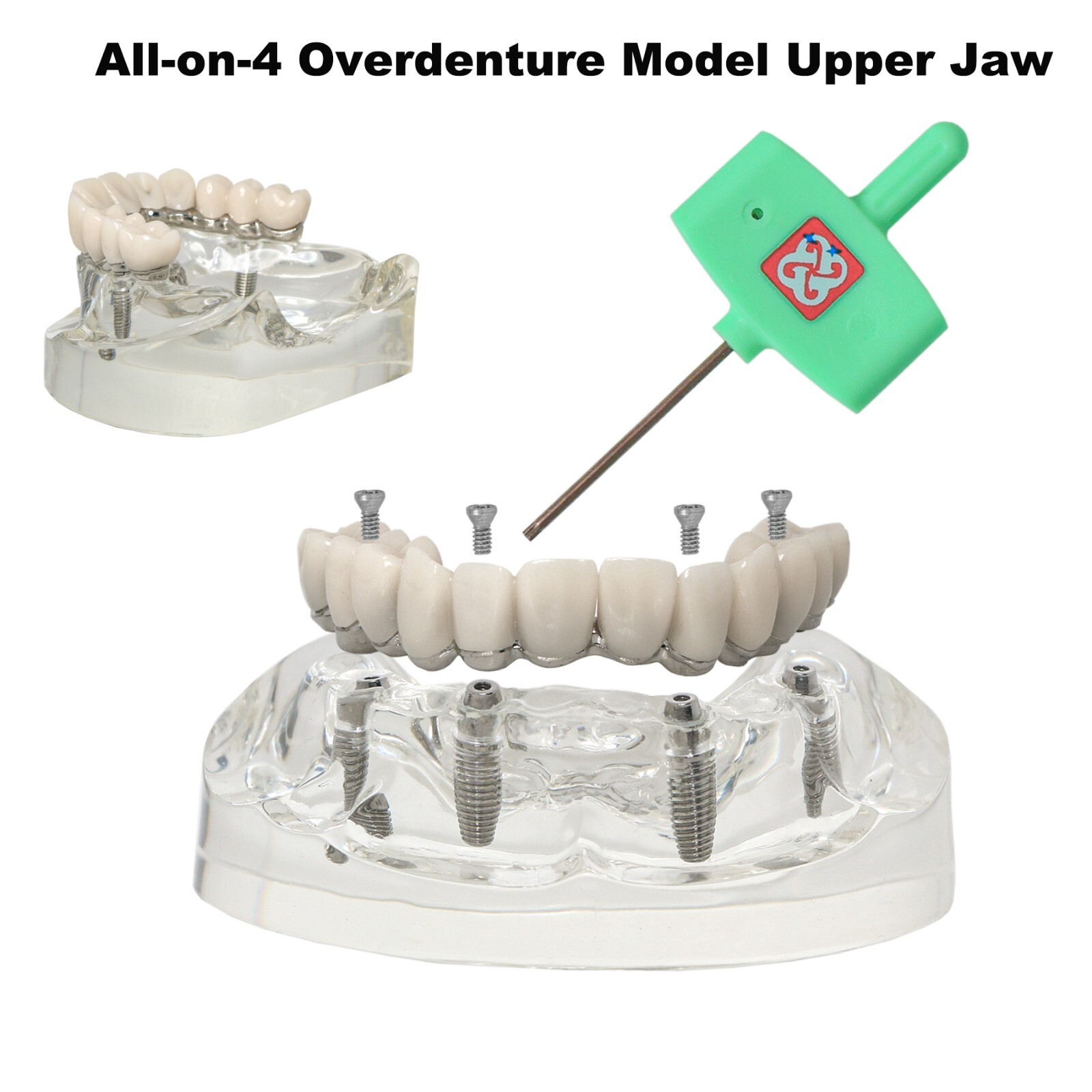 Implants Dental All-on-4 Overdenture Model Upper Jaw Restoration 4 Screws M6023