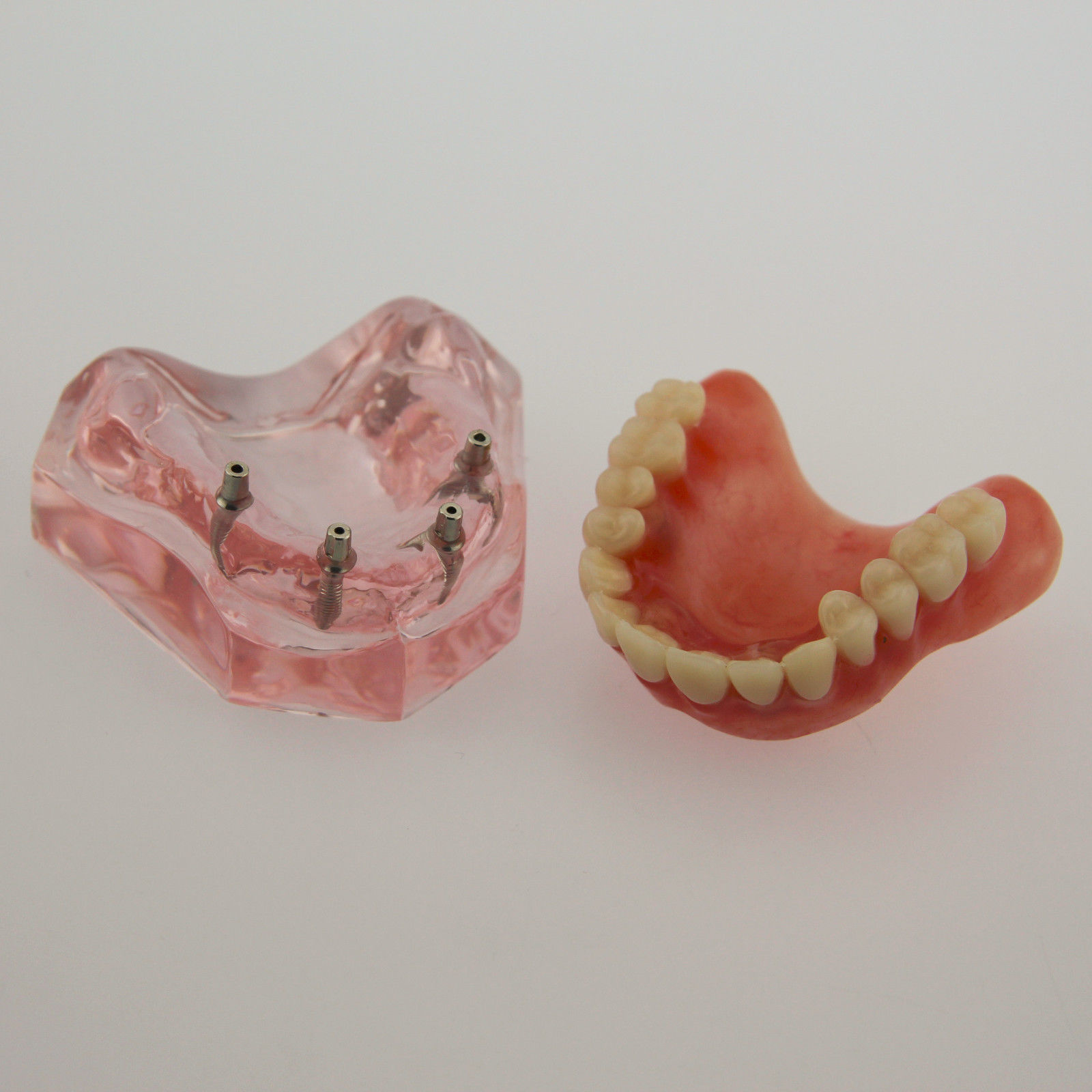 Dental Implants Restoration Model Overdenture Inferior With Demo Teaching Study