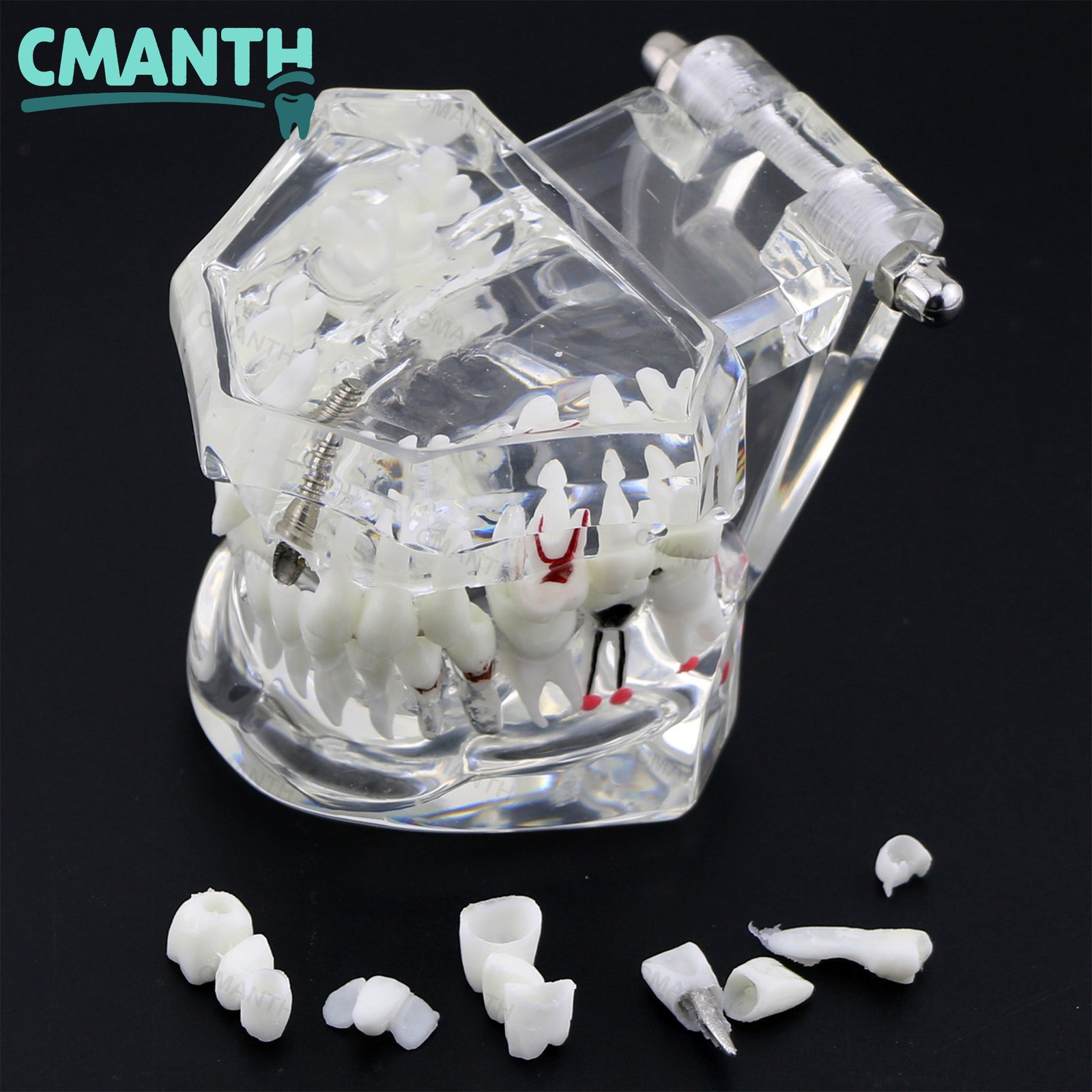 Dental Model Bridge Restoration Pathology Study Demo Teaching Model M2001