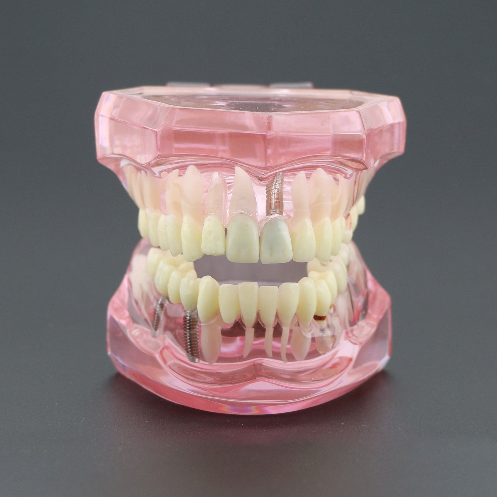 Dental Implant Teeth Model Teach Study Demo Restoration Pathology #2001 Pink