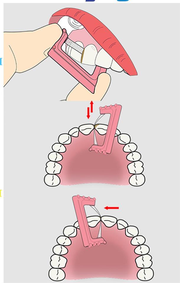 Dental Orthodontic IPR Reduction Strip Interproximal Enamel Strips Polishing saw