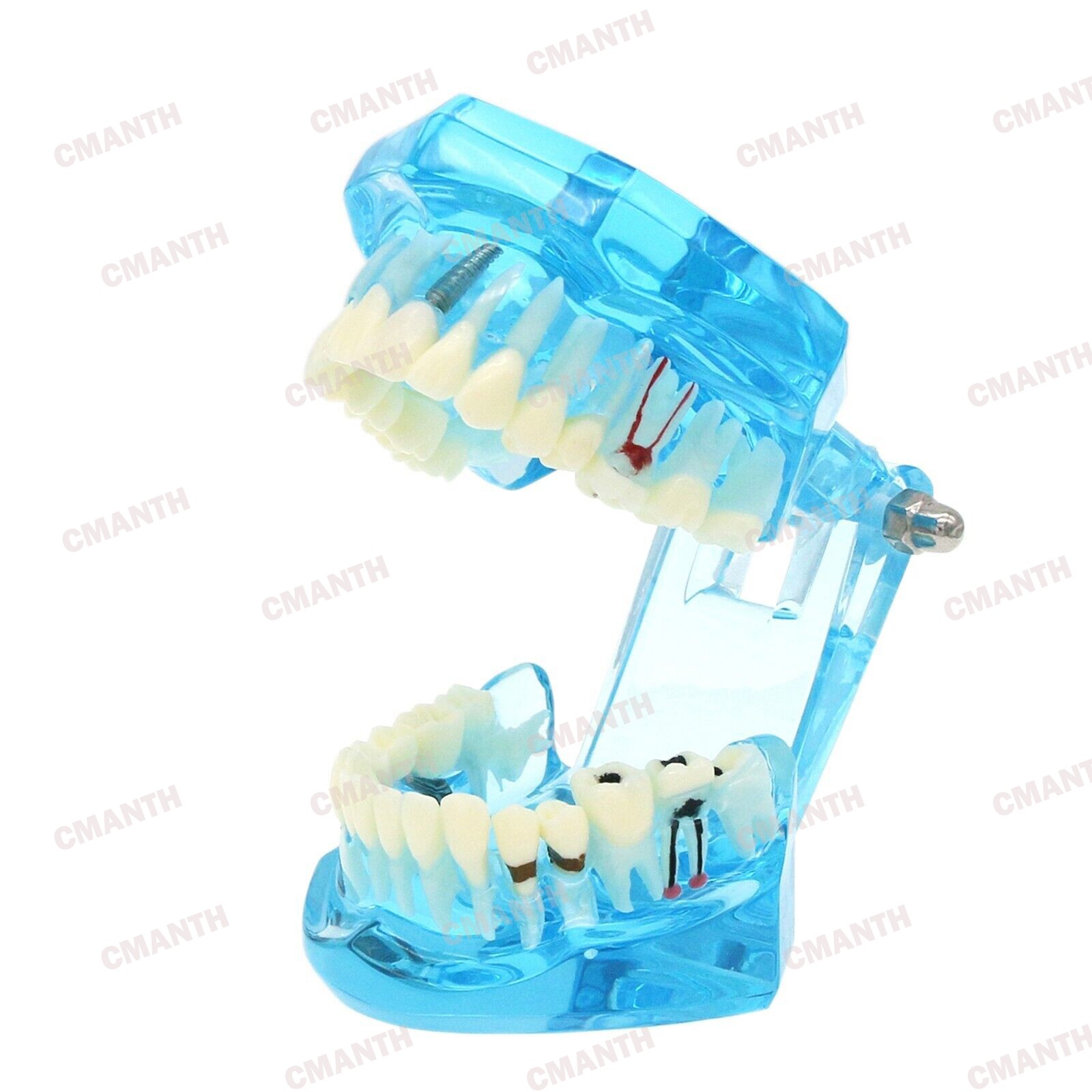 Dental Teeth Model Ortho Implant Practice Teaching of Implants Demo Model