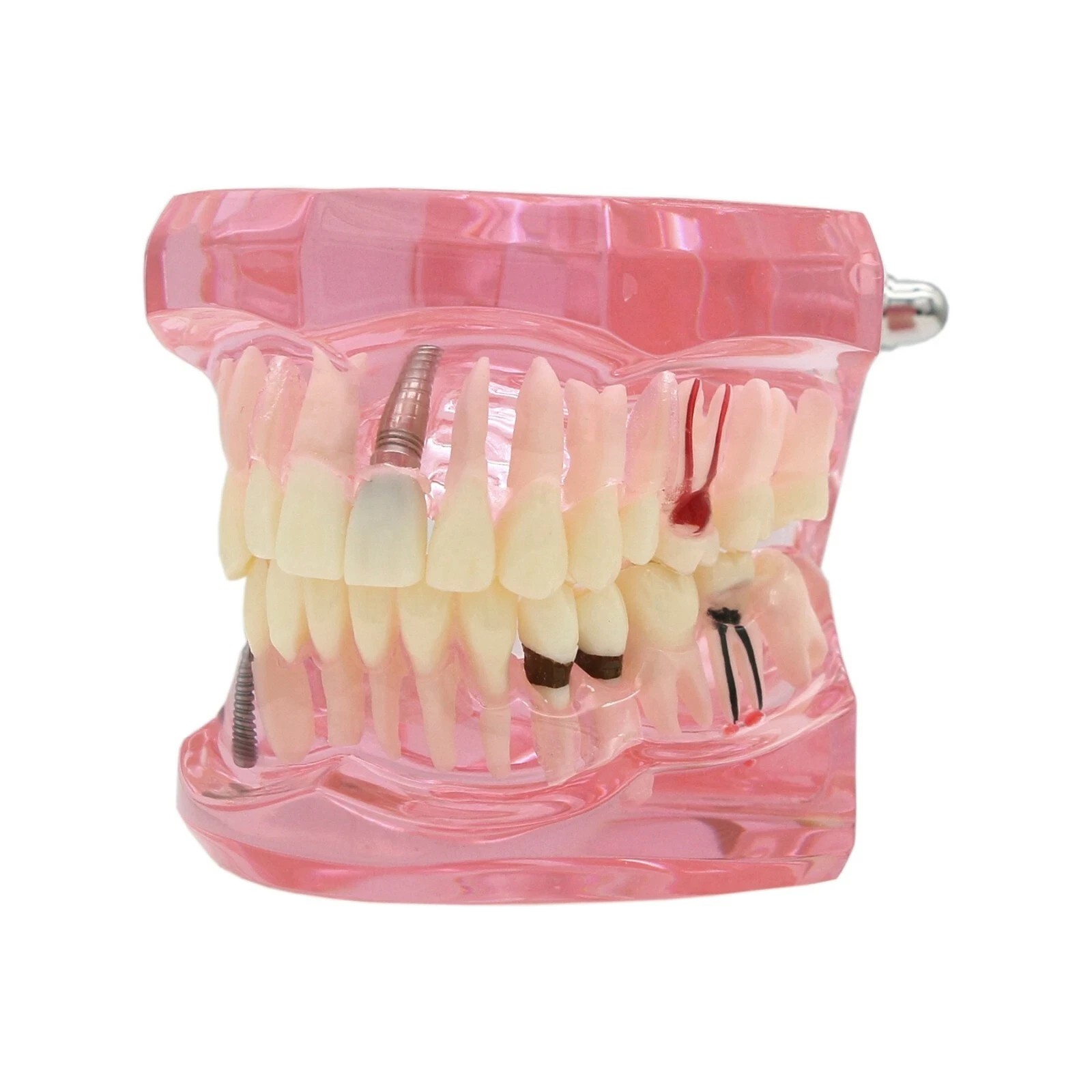 Dental Implant Teeth Model Teach Study Demo Restoration Pathology #2001 Pink