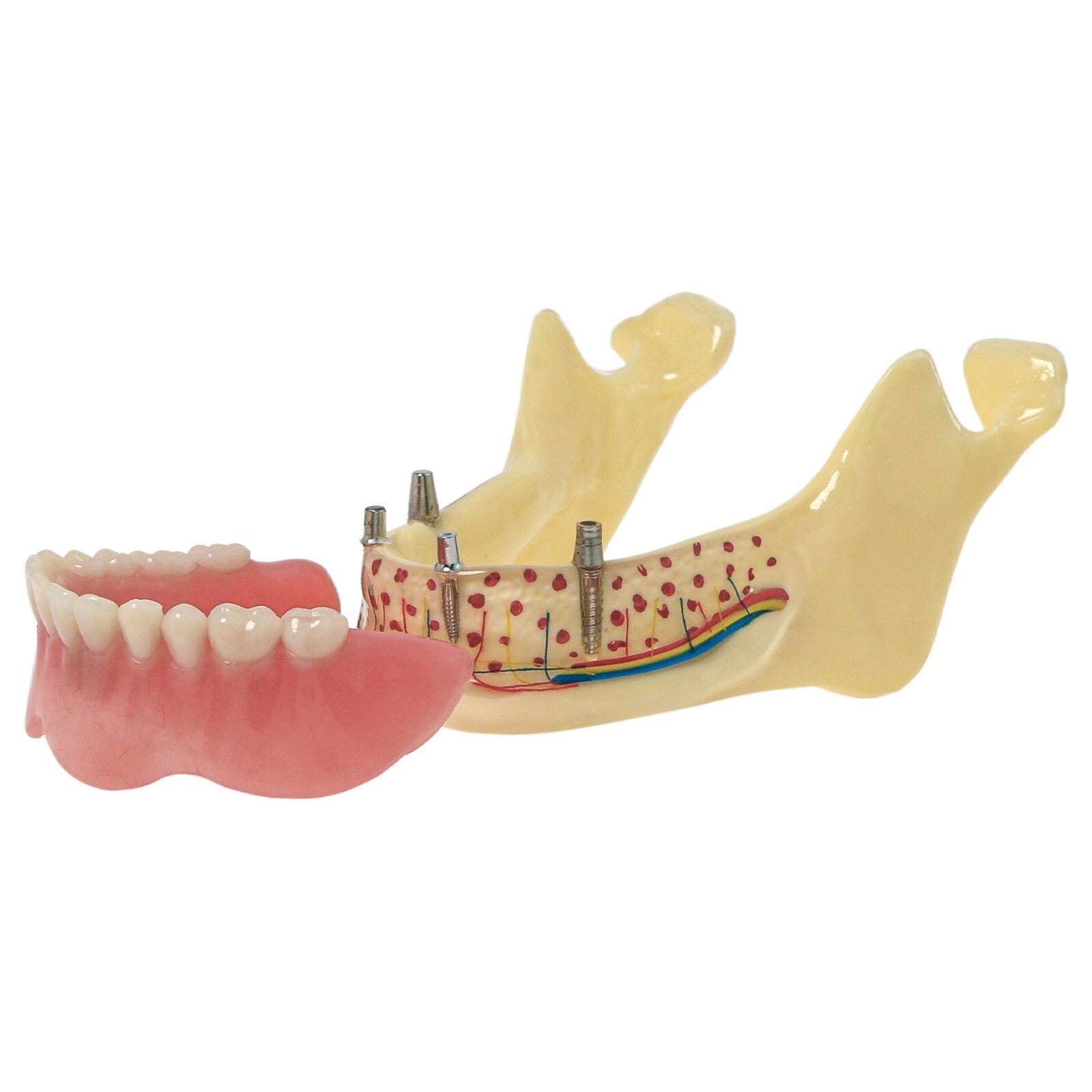 Dental Implant Training Model Upper / Lower Jaw with Overdenture Demo & Base