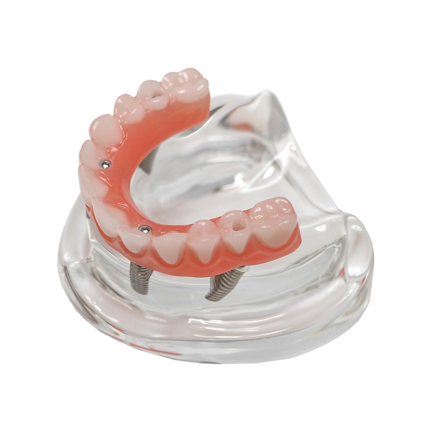 Dental Overdenture Implant Model All-on-4/6 Upper Jaw Restoration 4/6 Screws