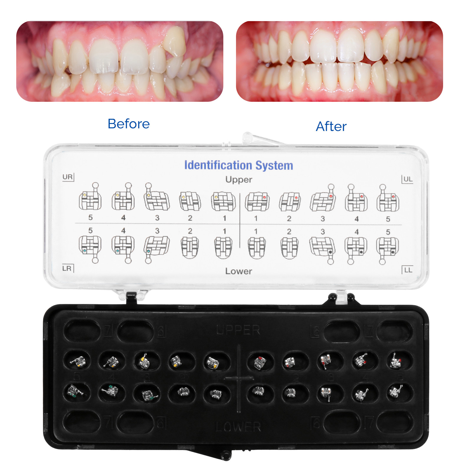 Orthodontic Metal Brackets Standard Roth/MBT Braces .022/.018 Hooks 3-4-5 20/Set