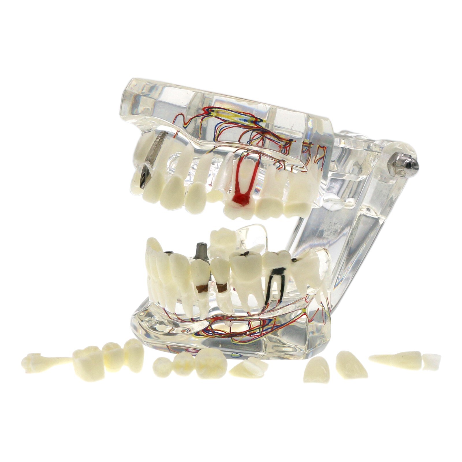 Dental Typodont Teeth Model Implant Pathological Perio Restoration Practice Demo