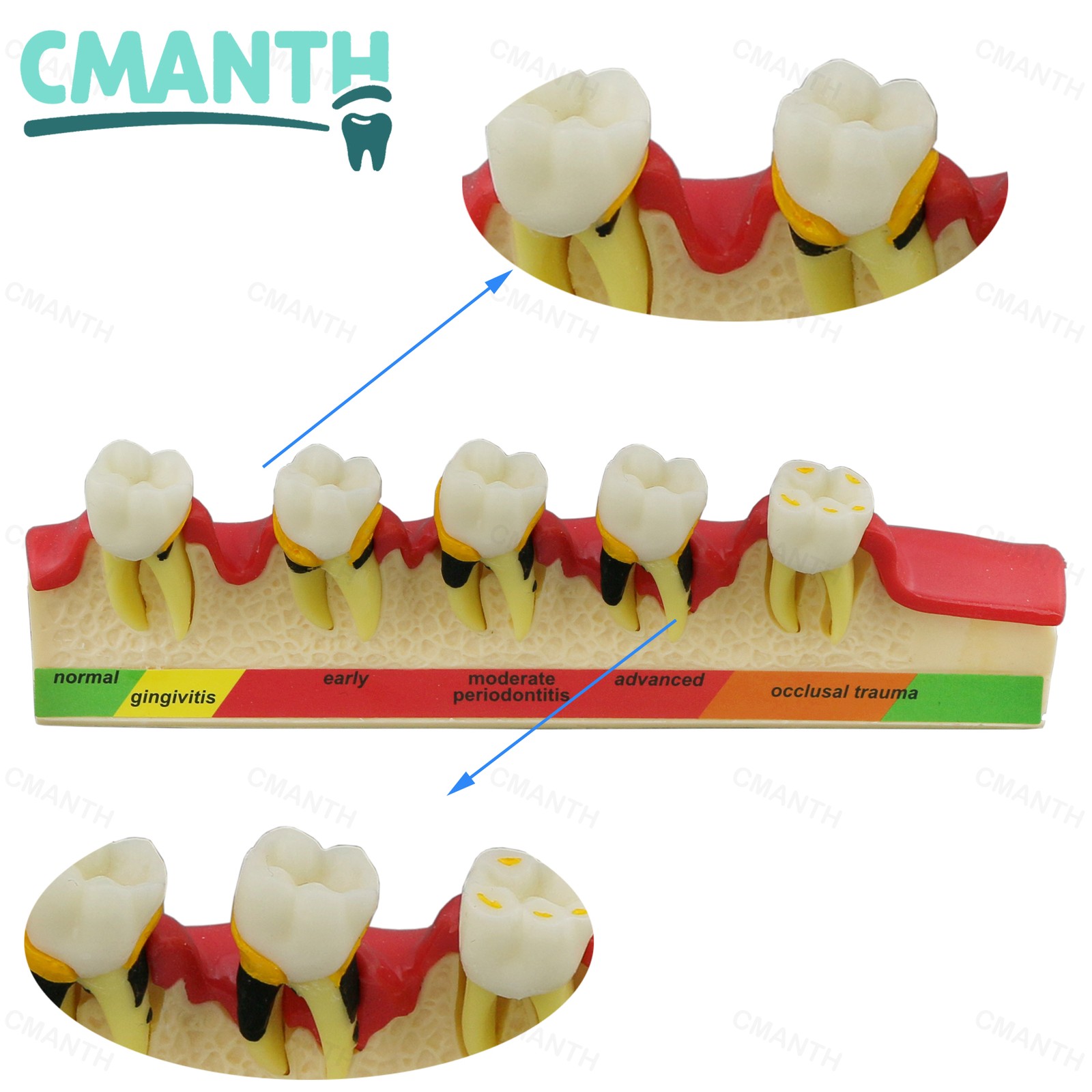Dental Pathological Model 5 Stage Periodontal Disease Patient Communication Demo