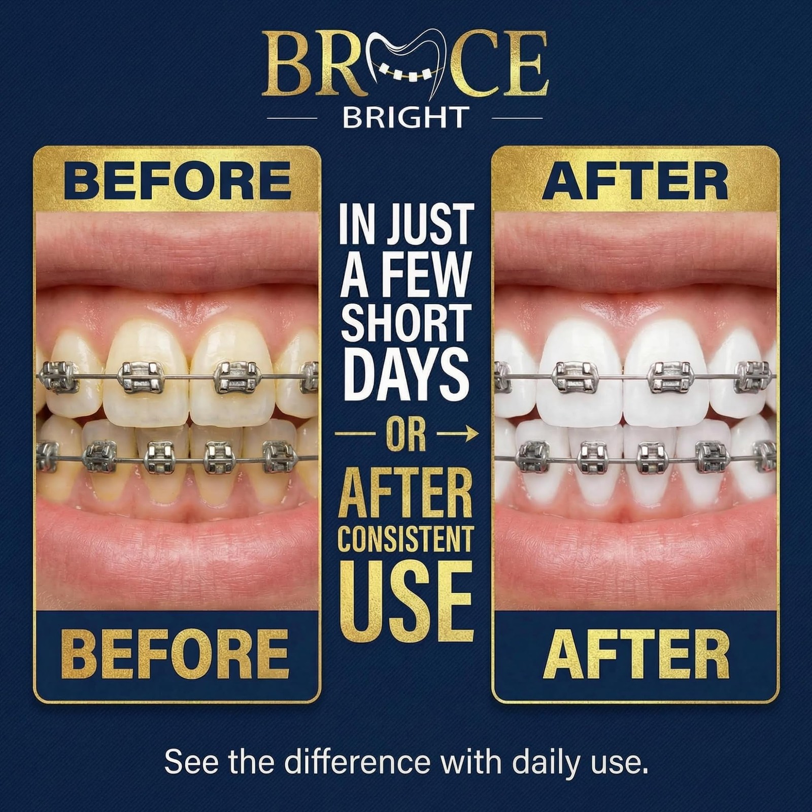 Teeth Whitening for Braces, Braces Cleaner Foam, Brace Teeth Whitening kit fo…