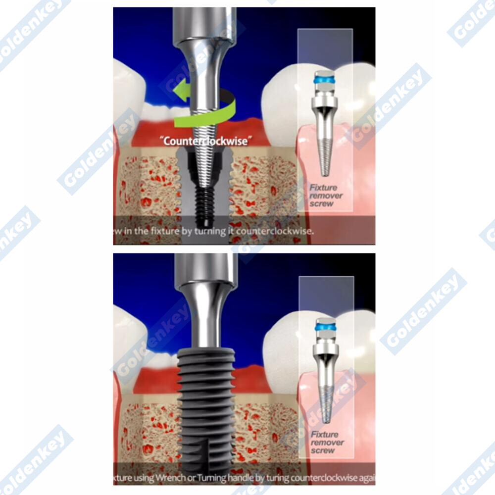 Dental Broken Implants Pick Up Extractor Failed Fixture Remove SOS Screws US USA