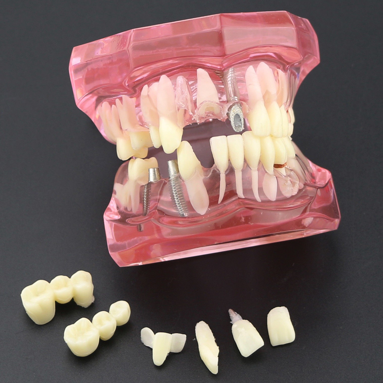 Dental Implant Teeth Model Teach Study Demo Restoration Pathology #2001 Pink