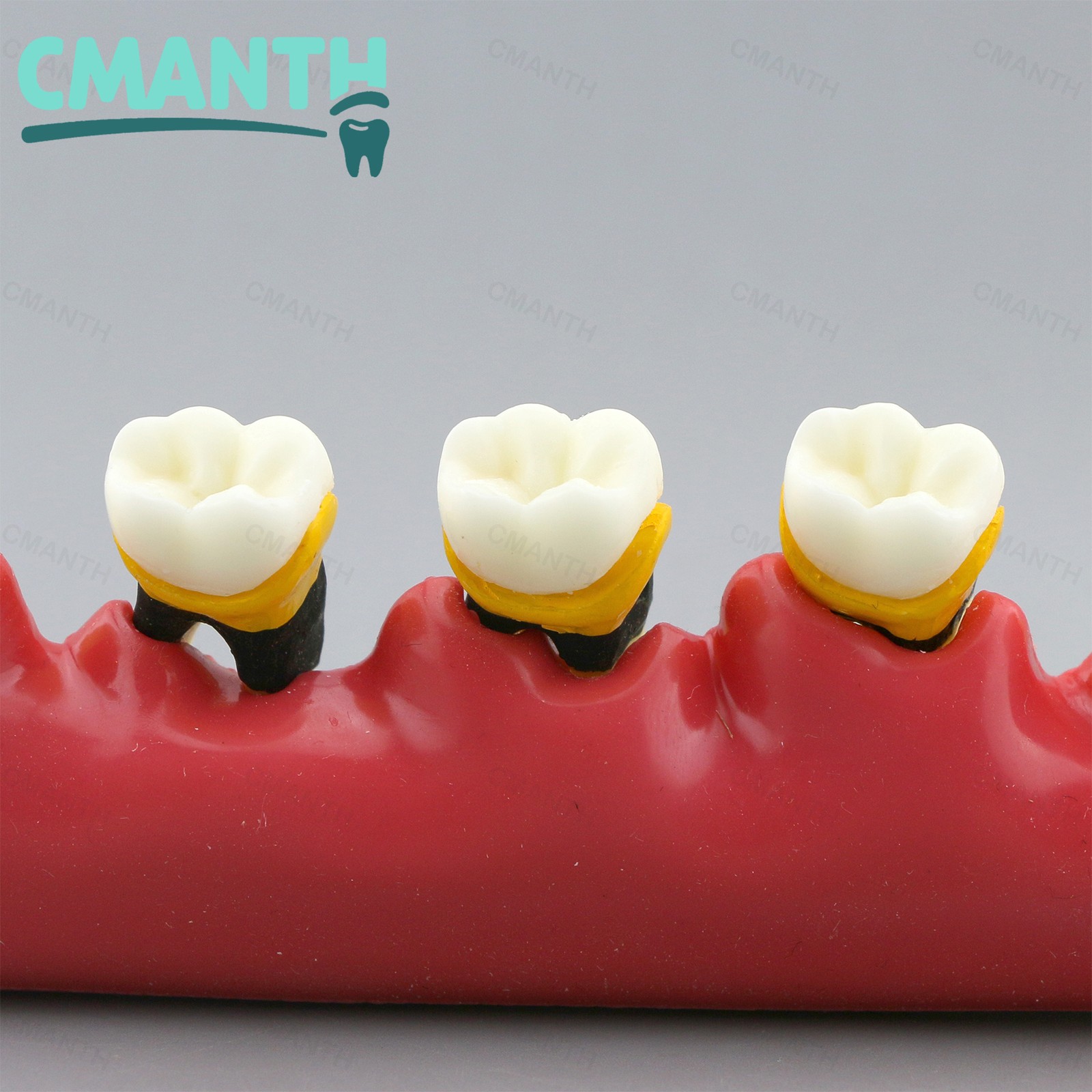 Dental Pathological Model 5 Stage Periodontal Disease Patient Communication Demo