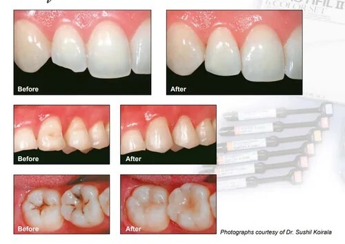 Shofu Beautifil Basic Nano Universal Dental Composite Kit