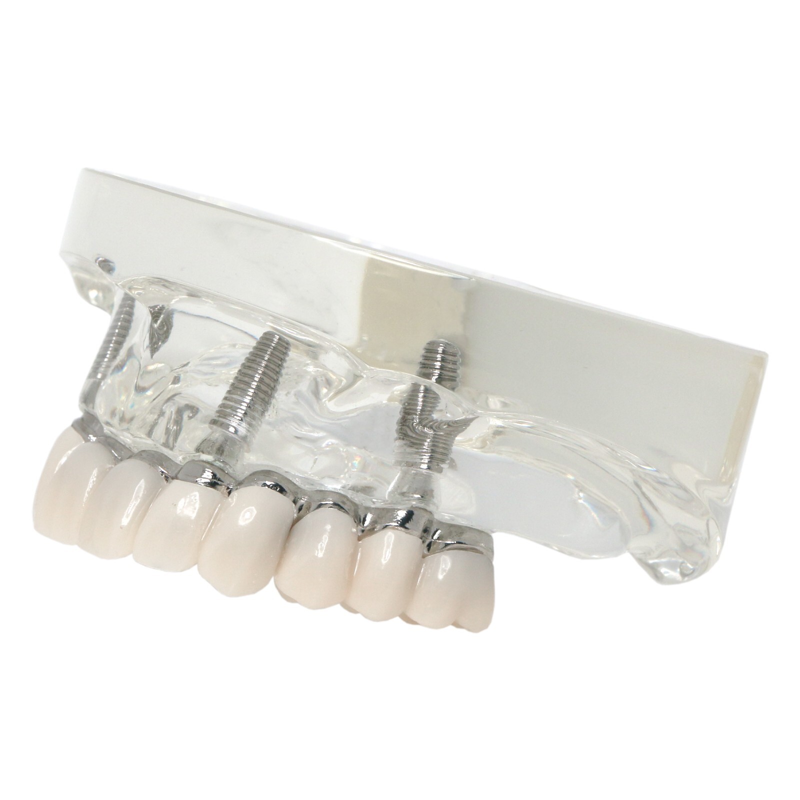 All-on-4 Overdenture Clear Model Dental Implant Upper Jaw Restoration 4 Screws
