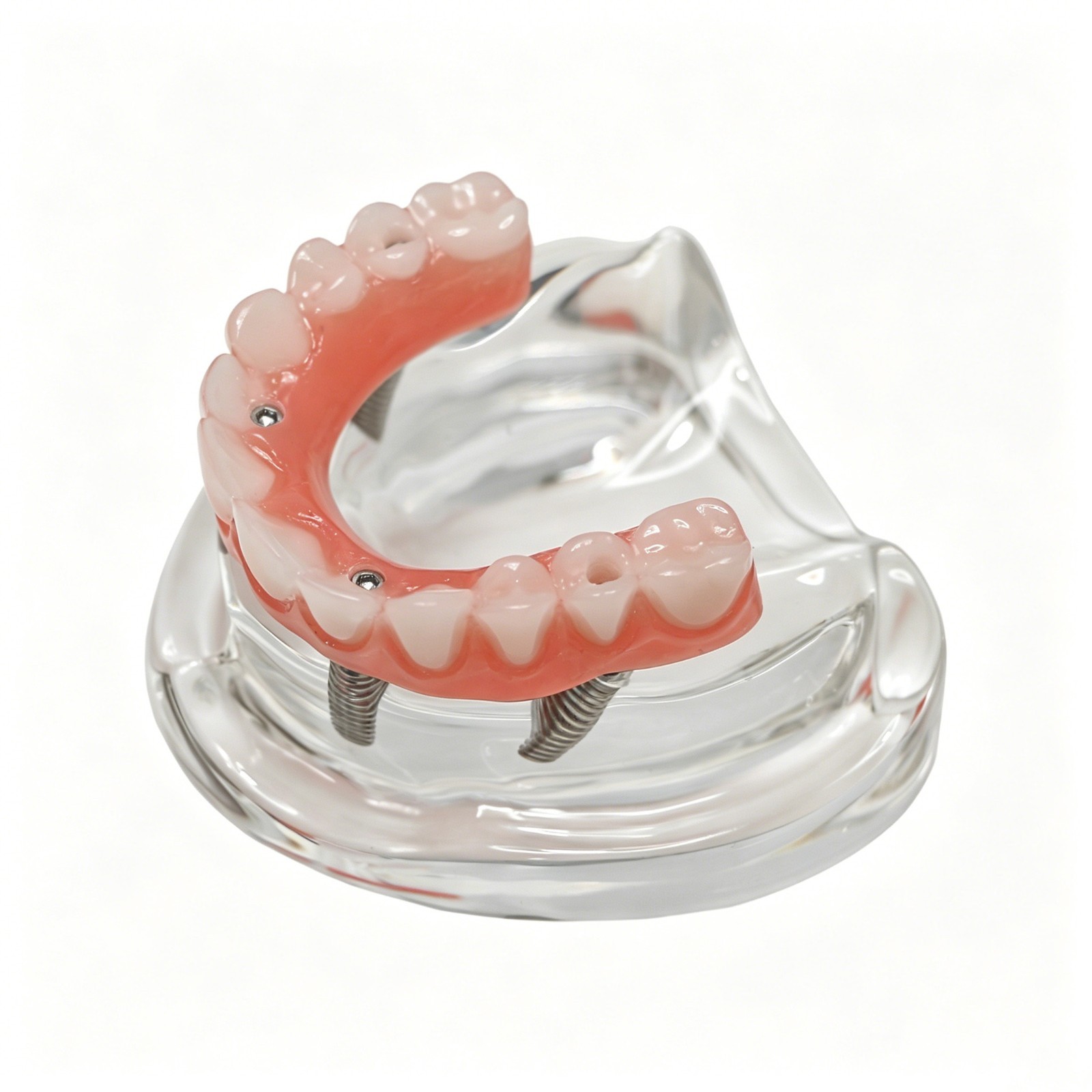 USAll on 4 Dental Implant Model Overdenture Upper Jaw 4 Implant Clear Detachable